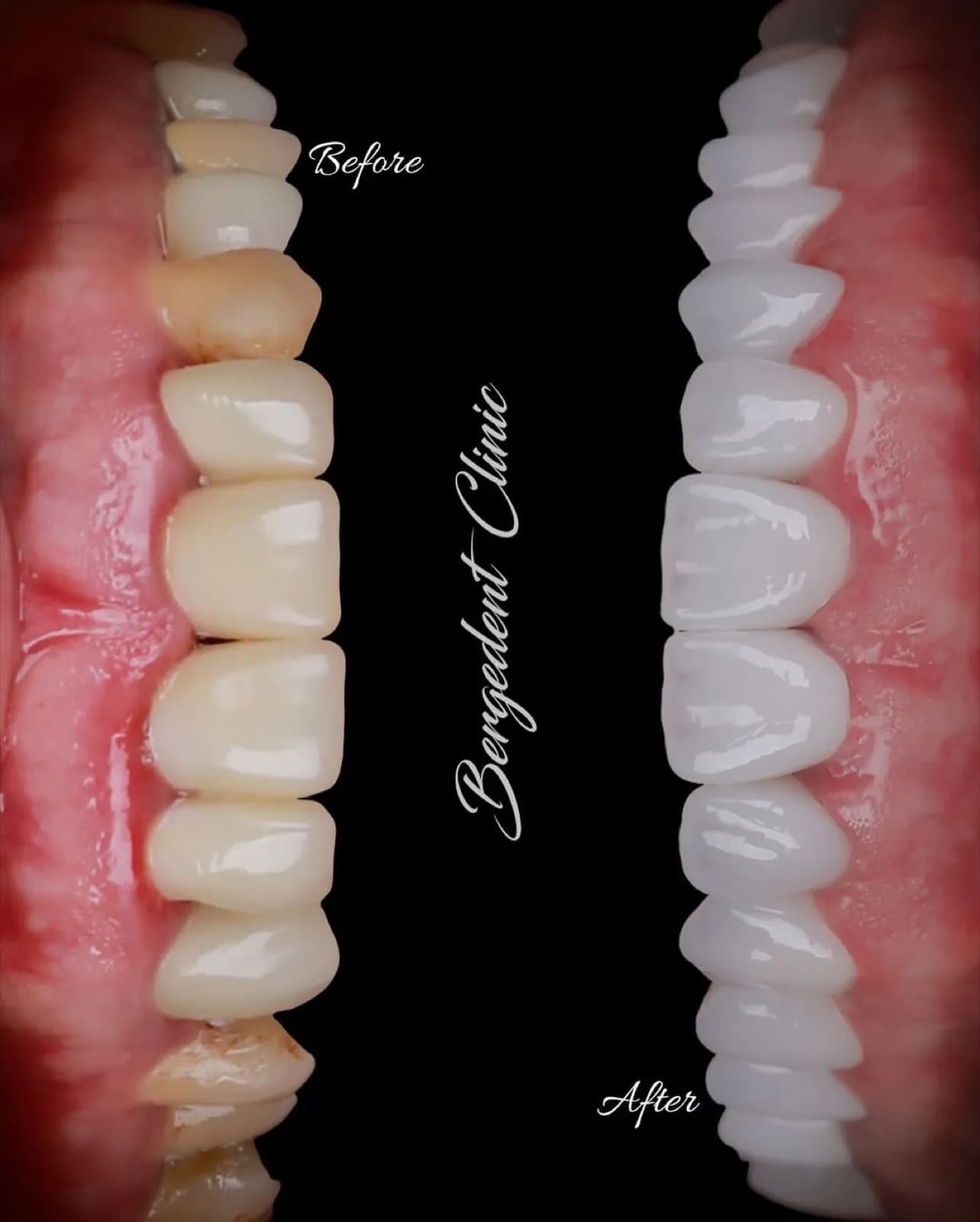 Before and after veneer treatment, side-by-side comparison of discolored versus white teeth, Turkey dental clinic.