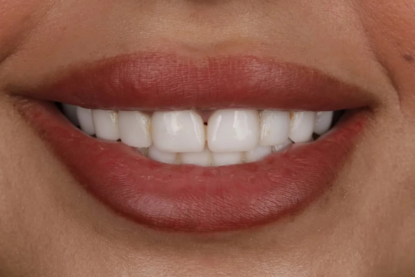 Before and after dental treatment, close-up comparison of natural versus white porcelain veneer teeth, Turkey dental clinic.