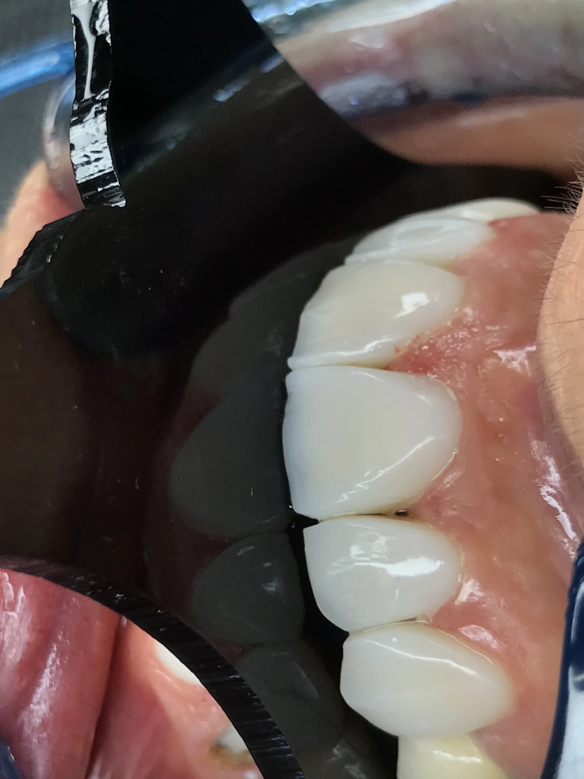 Veneers & smile design after — case 1, NexWell partner clinic, Istanbul