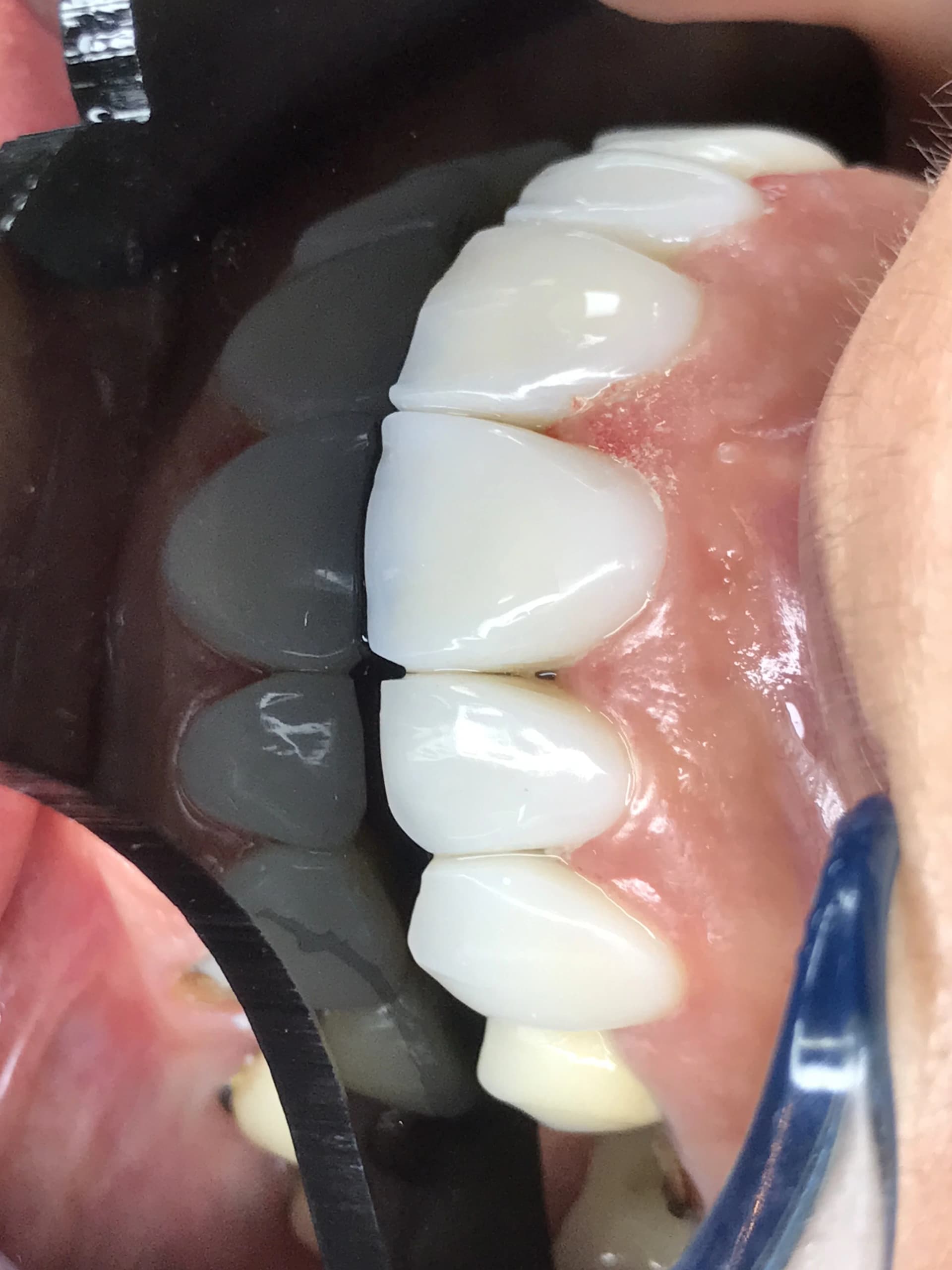 Veneers & smile design before — case 1, partner clinic, Istanbul