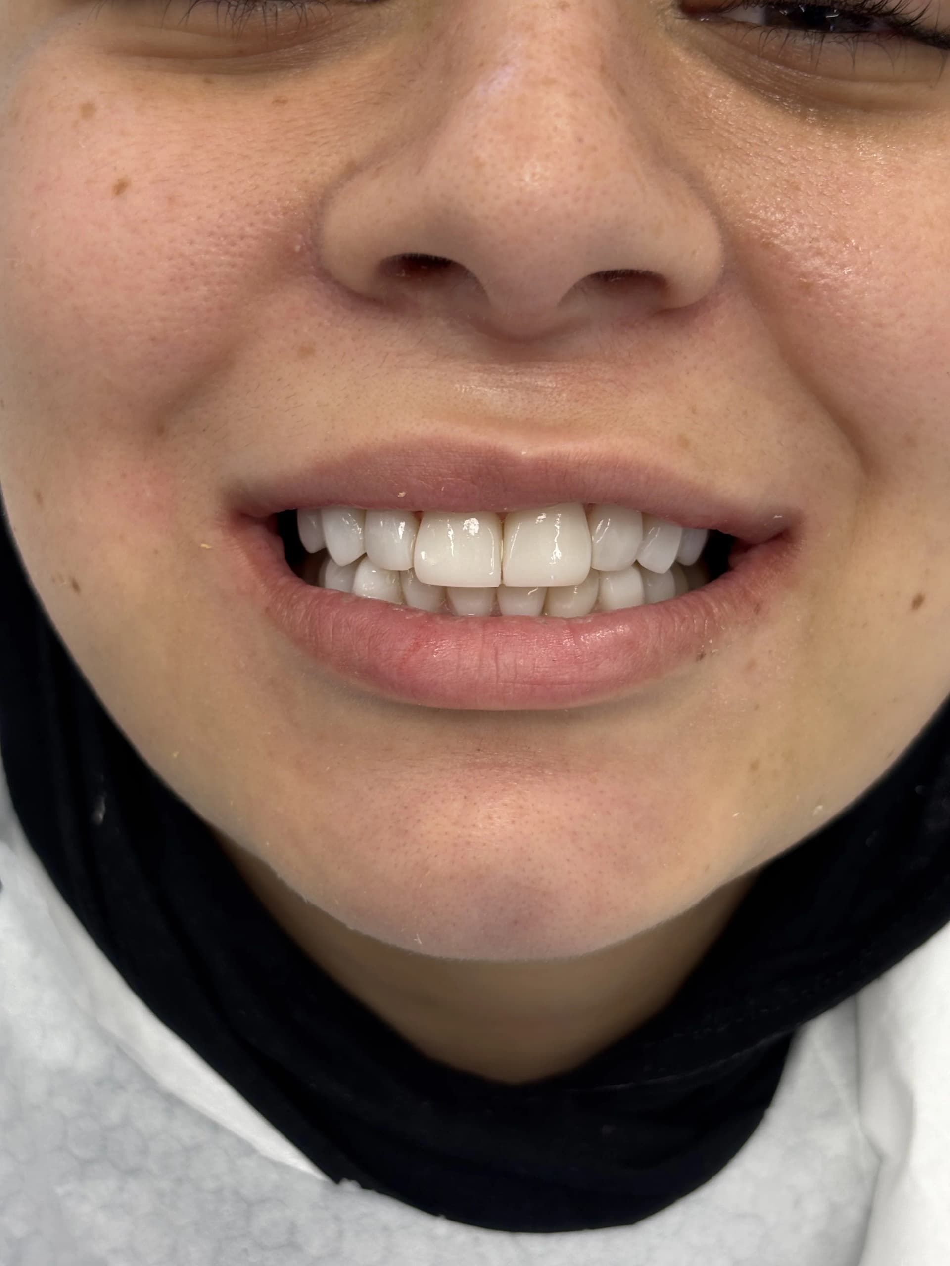 Smile makeover after — case 2, NexWell partner clinic, Istanbul