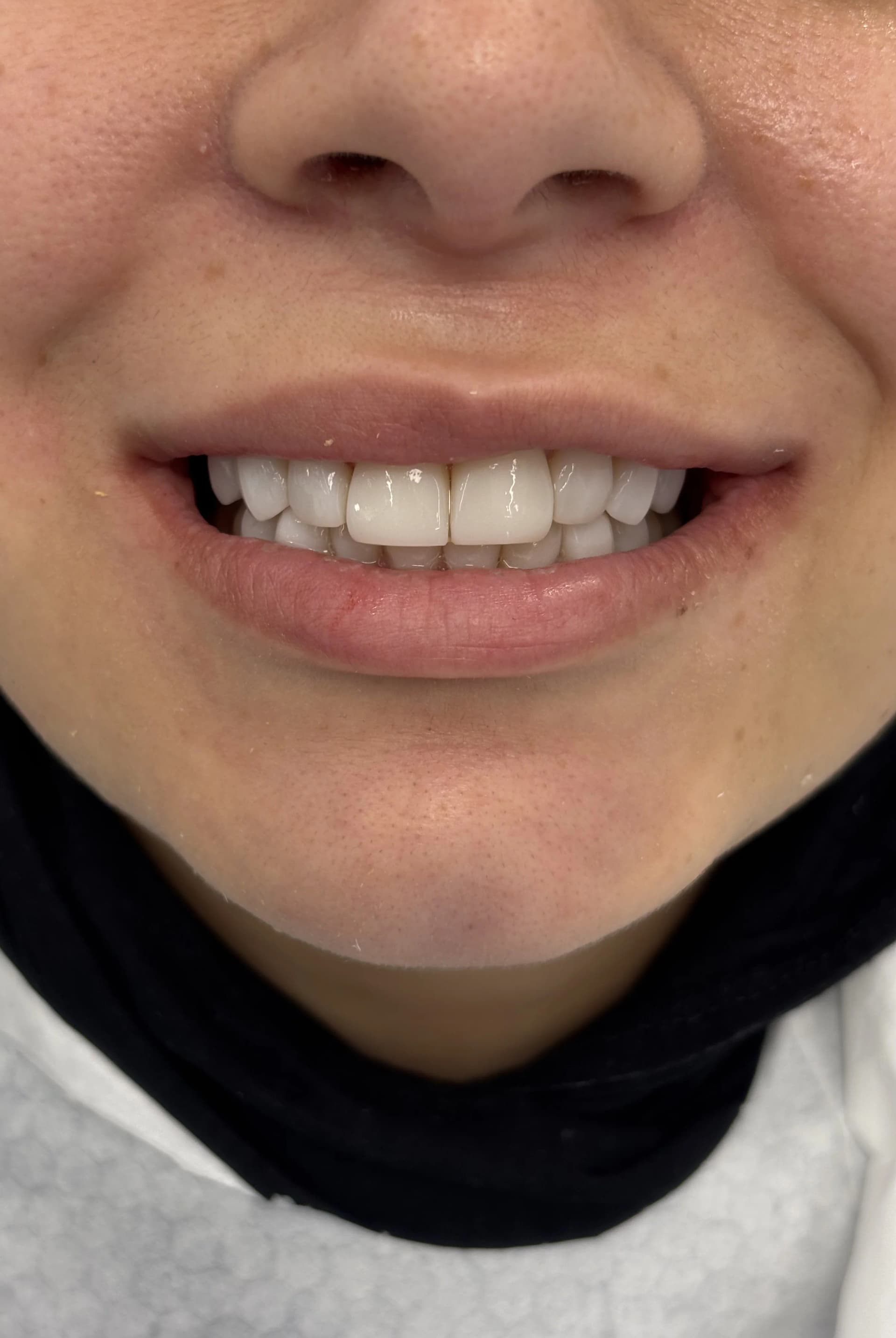 Smile makeover before — case 2, partner clinic, Istanbul