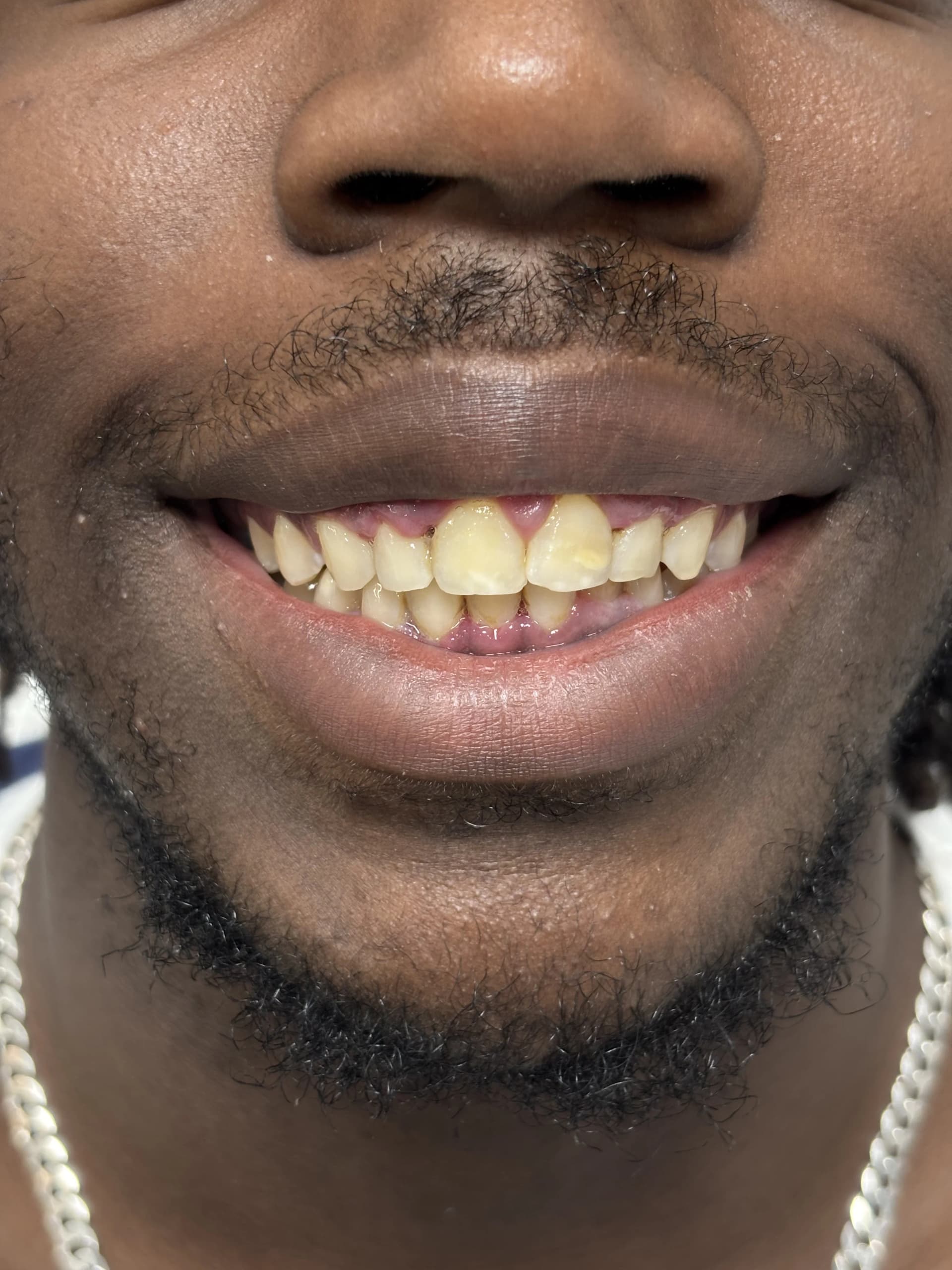 Implant & full-arch restoration after — case 3, NexWell partner clinic, Istanbul