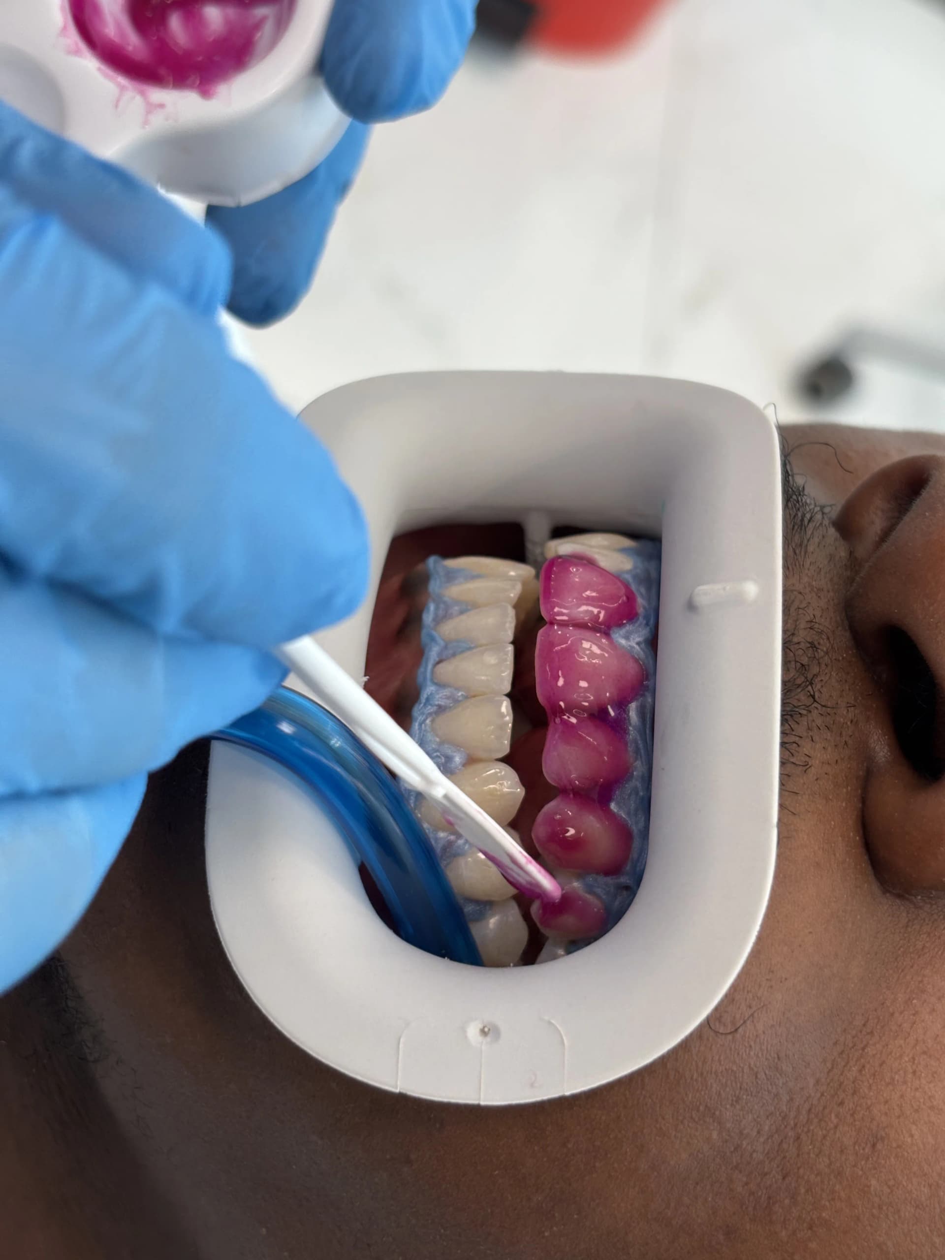 Veneers & smile design after — case 4, NexWell partner clinic, Istanbul