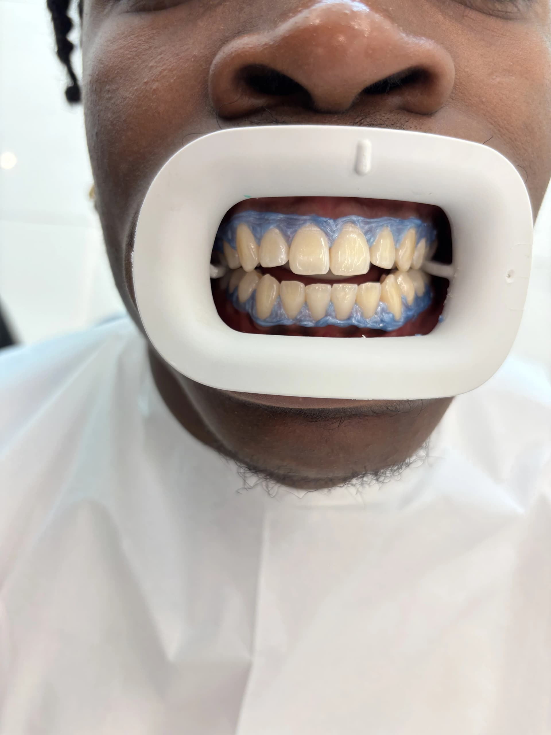 Veneers & smile design before — case 4, partner clinic, Istanbul