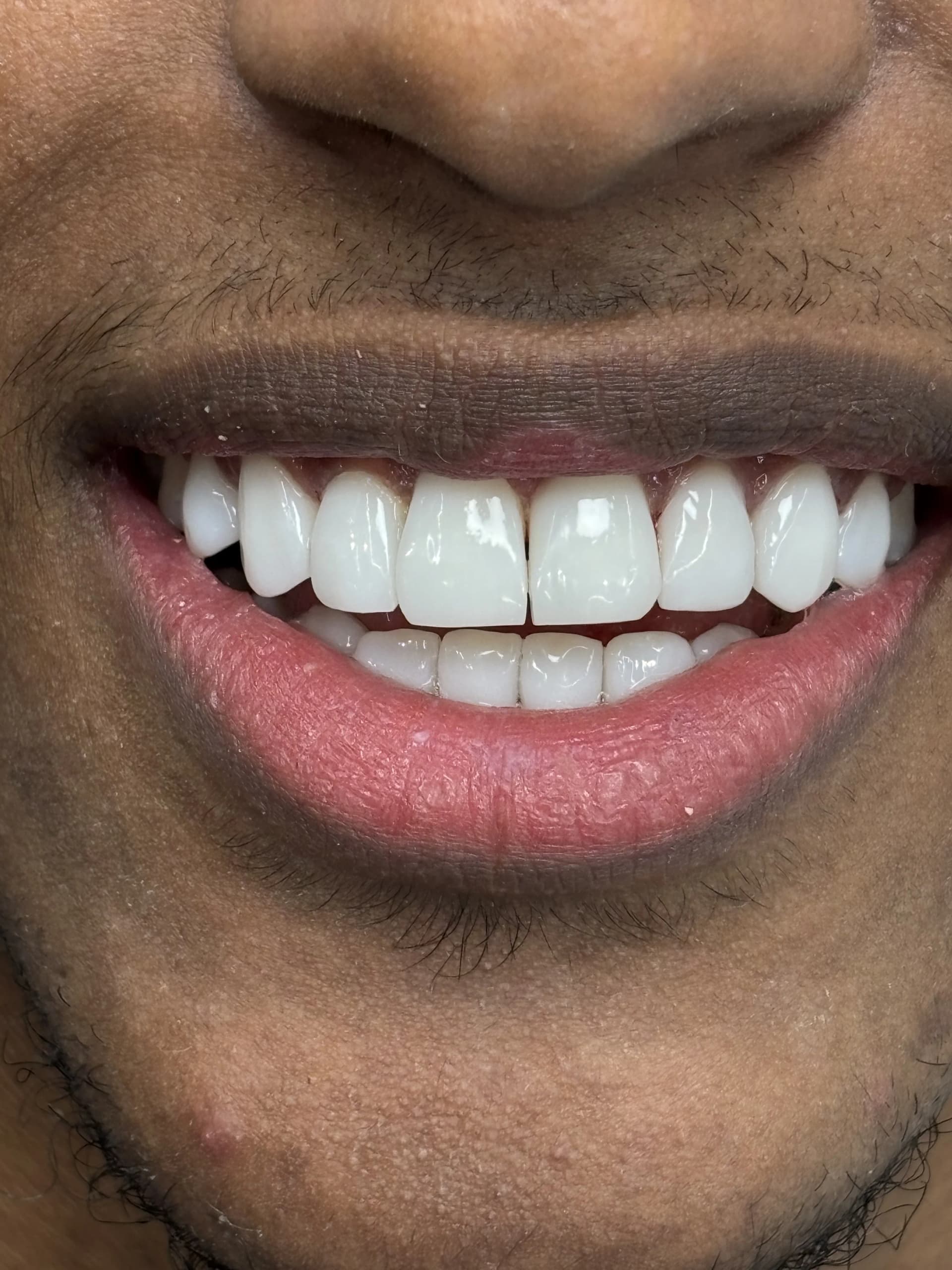 Smile makeover after — case 5, NexWell partner clinic, Istanbul