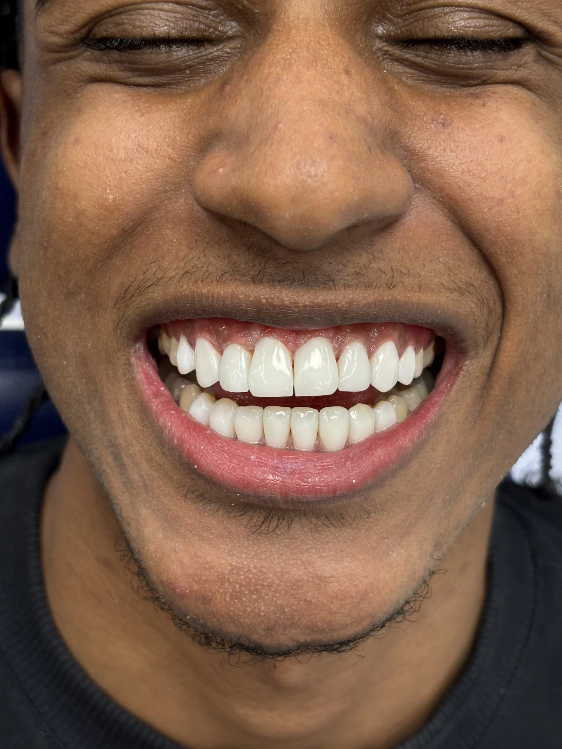 Smile makeover before — case 5, partner clinic, Istanbul