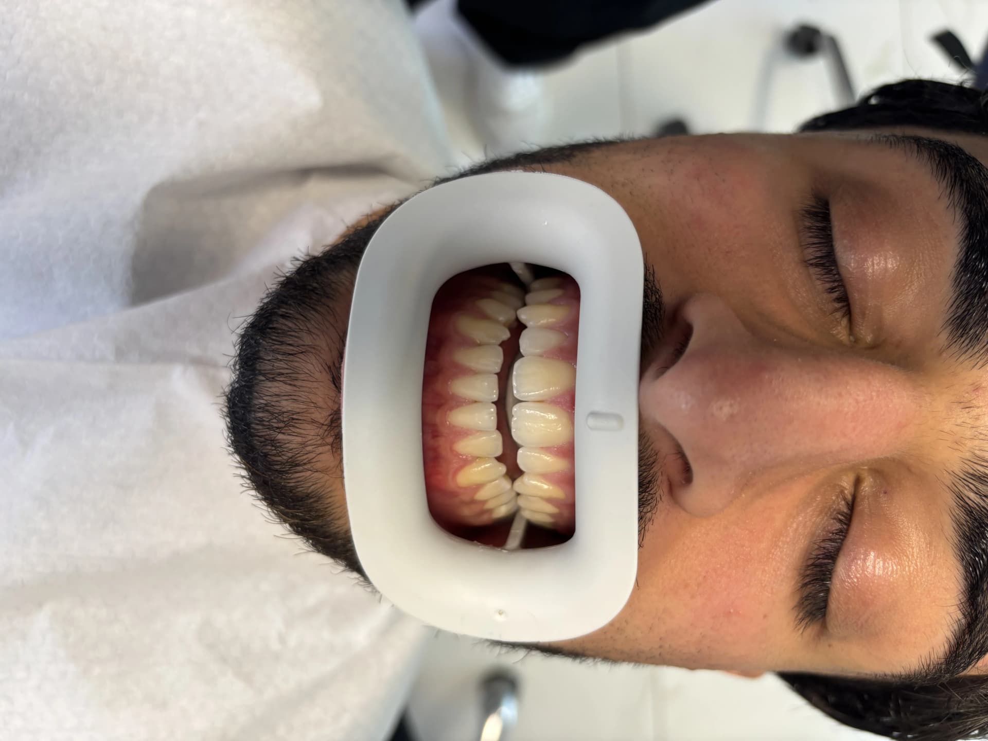 Implant & full-arch restoration after — case 6, NexWell partner clinic, Istanbul