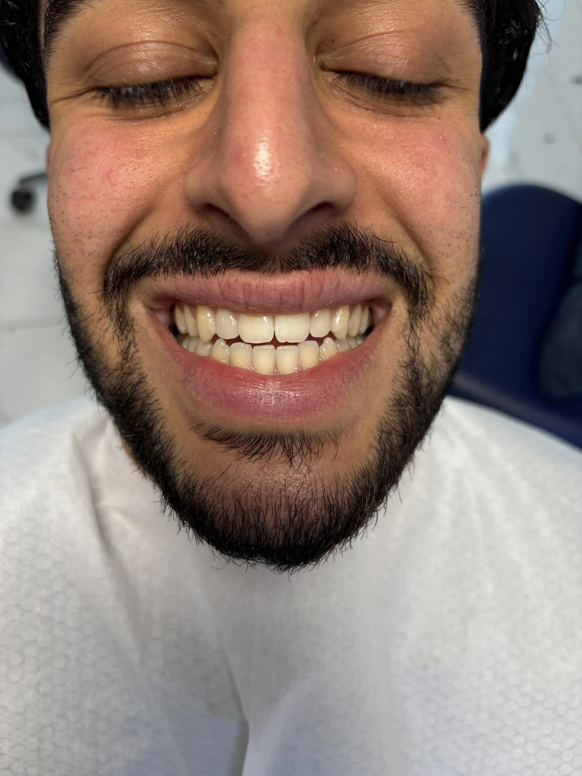 Implant & full-arch restoration before — case 6, partner clinic, Istanbul