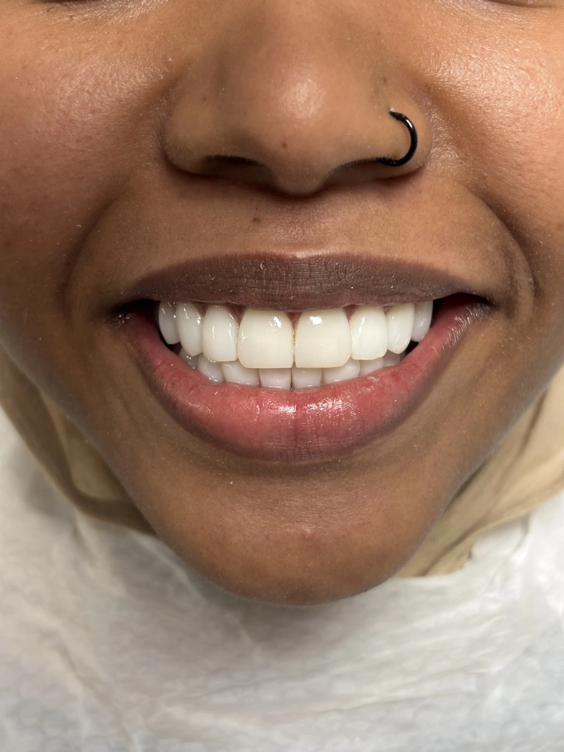 Veneers & smile design after — case 7, NexWell partner clinic, Istanbul