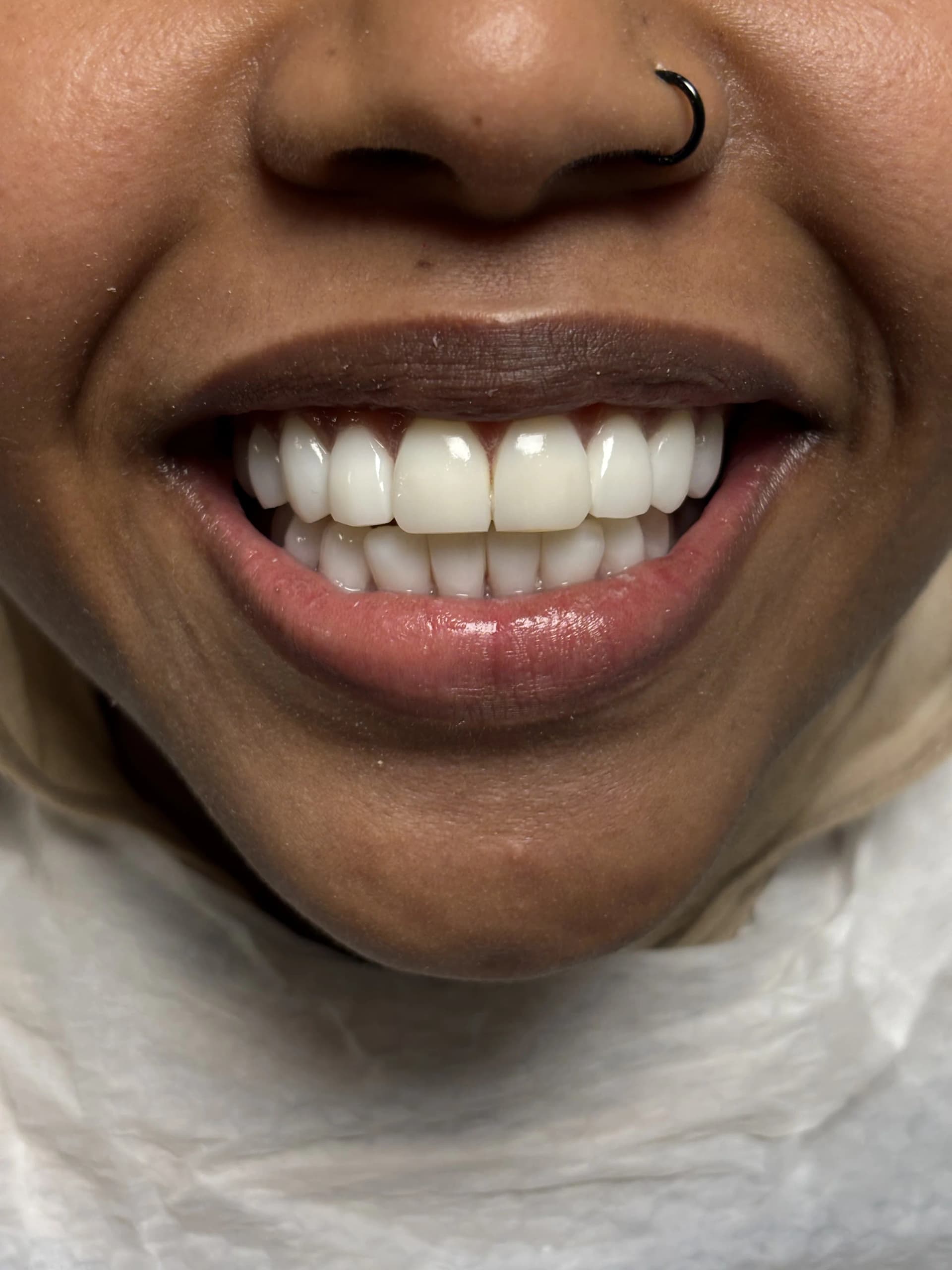 Veneers & smile design before — case 7, partner clinic, Istanbul