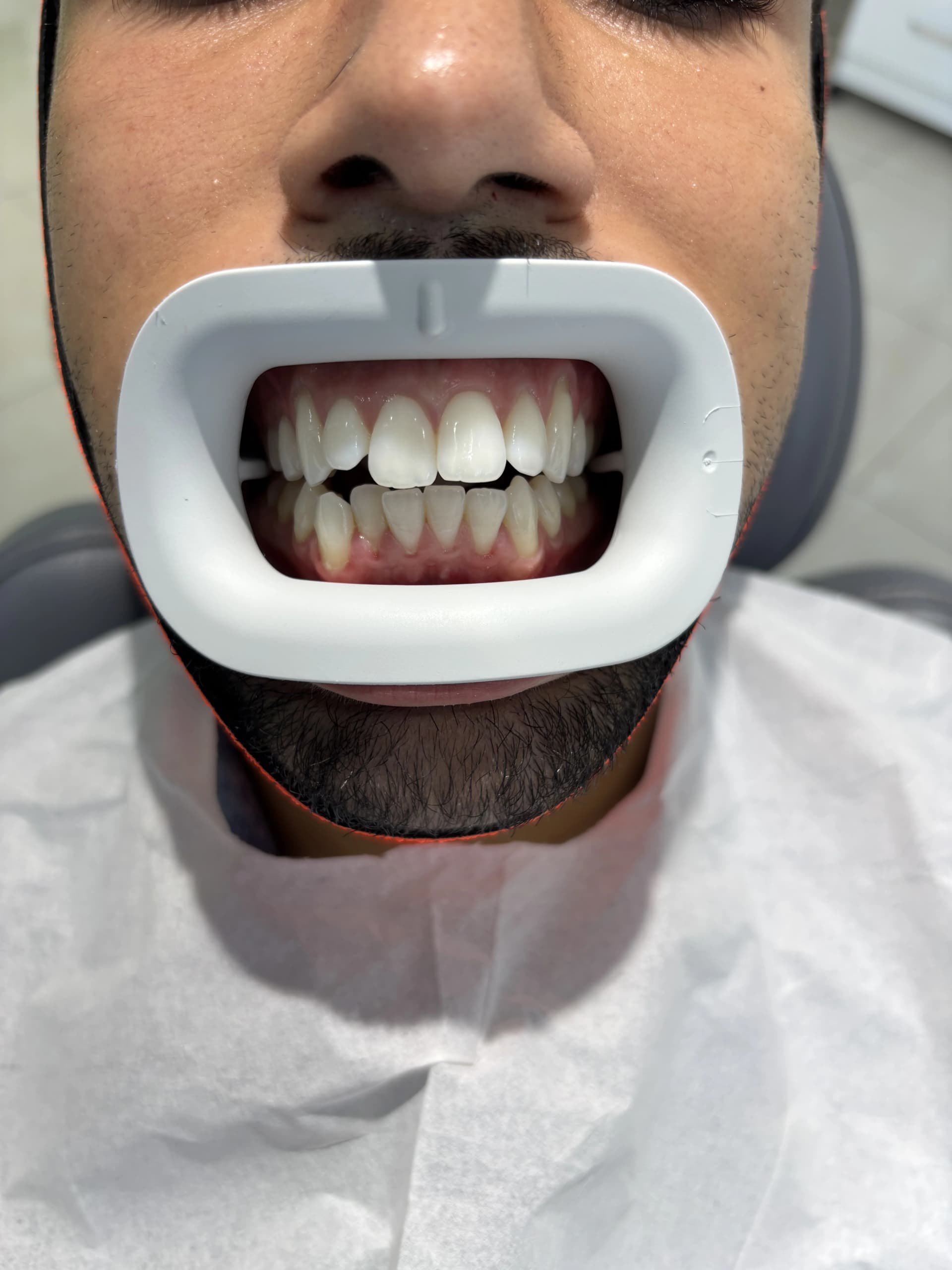Smile makeover after — case 8, NexWell partner clinic, Istanbul