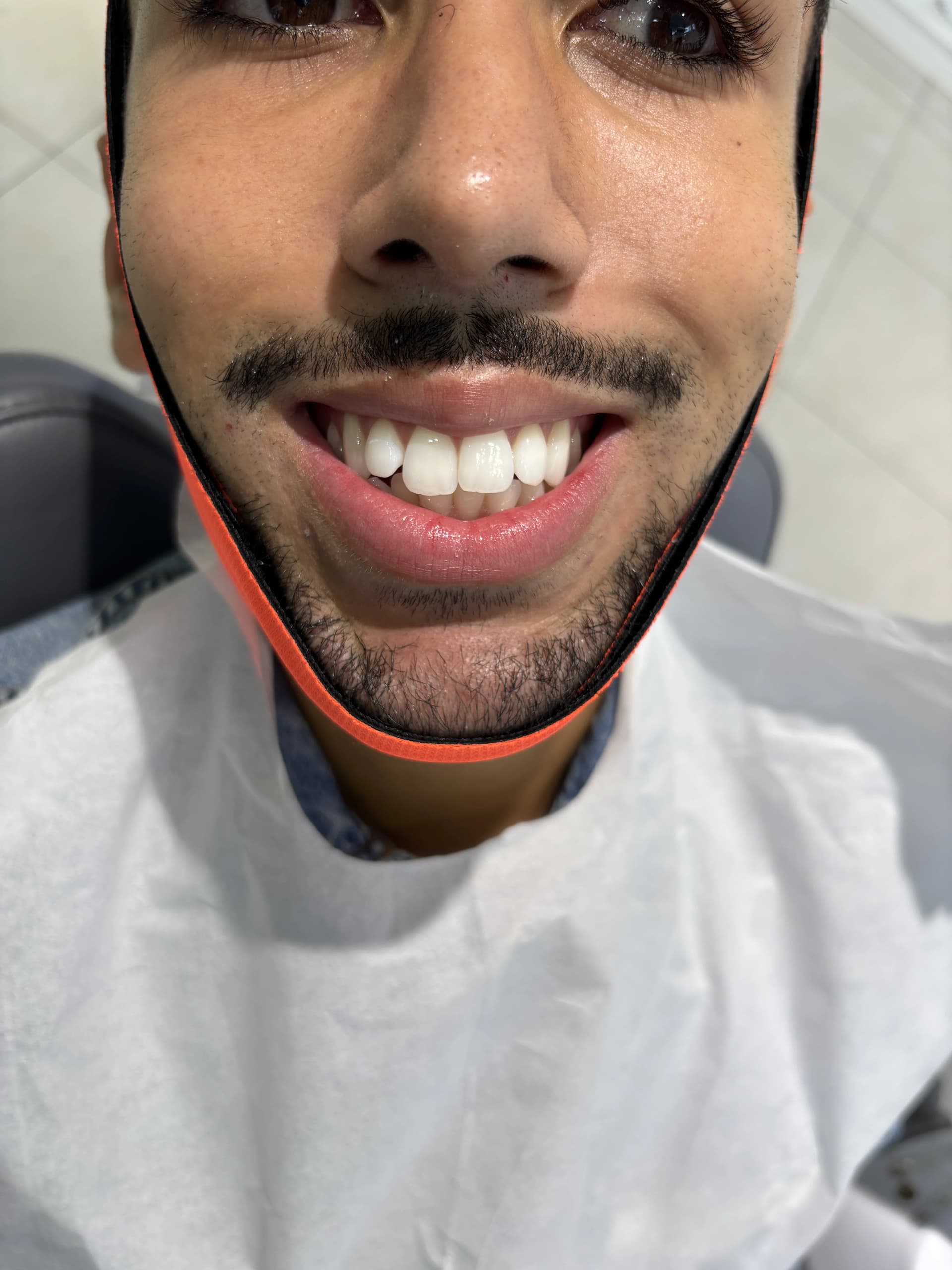 Smile makeover before — case 8, partner clinic, Istanbul