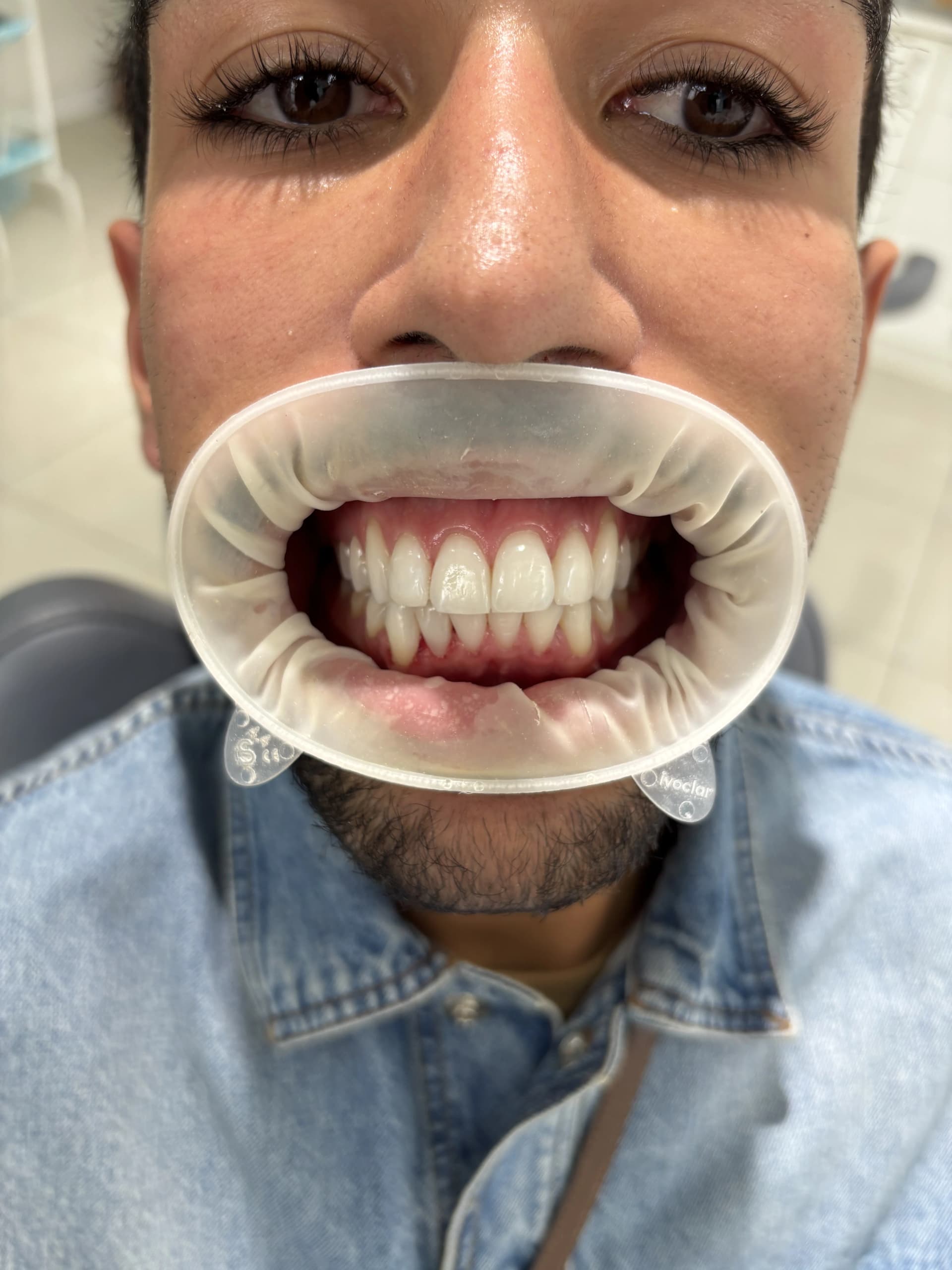 Implant & full-arch restoration after — case 9, NexWell partner clinic, Istanbul