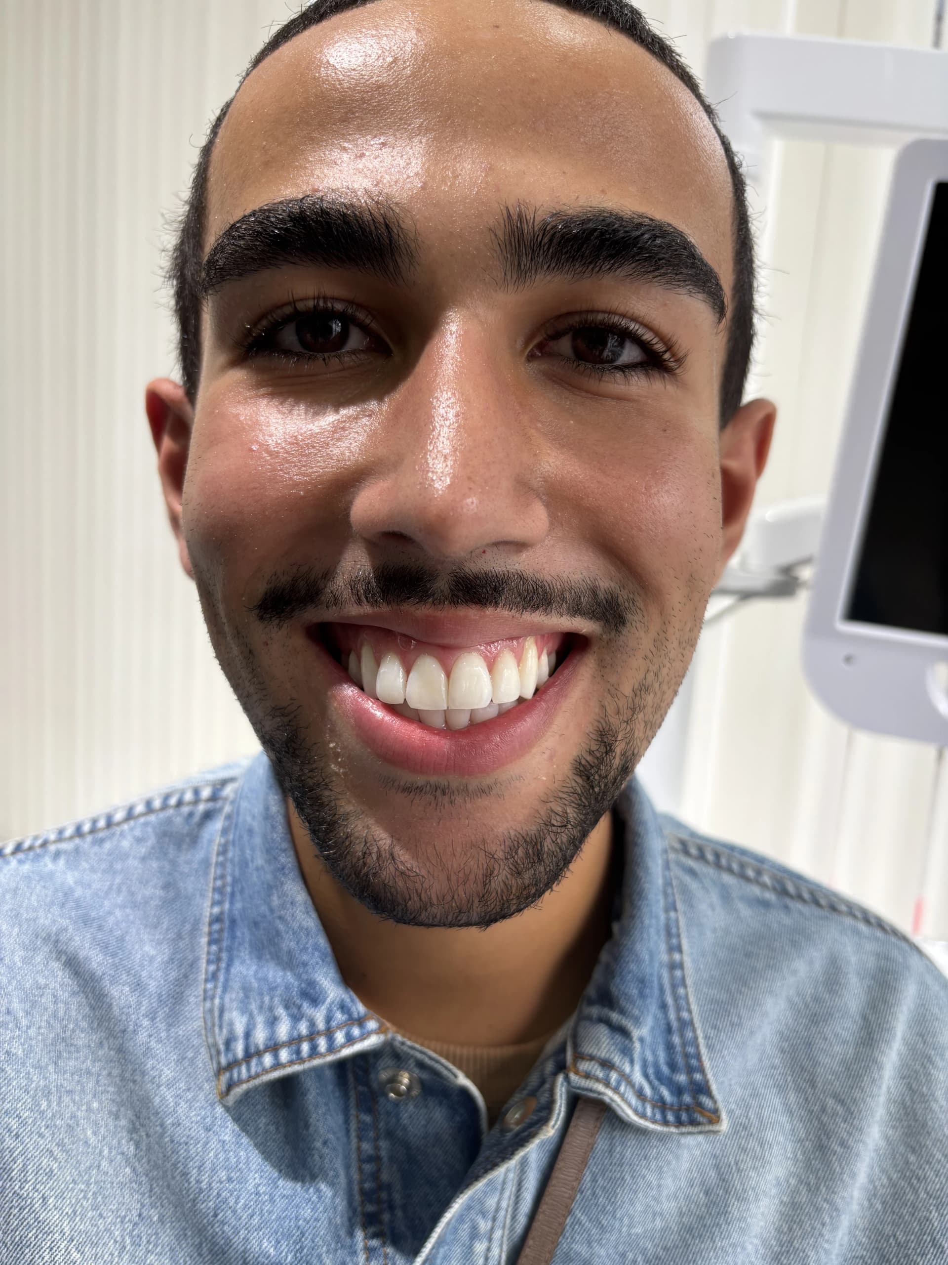 Implant & full-arch restoration before — case 9, partner clinic, Istanbul