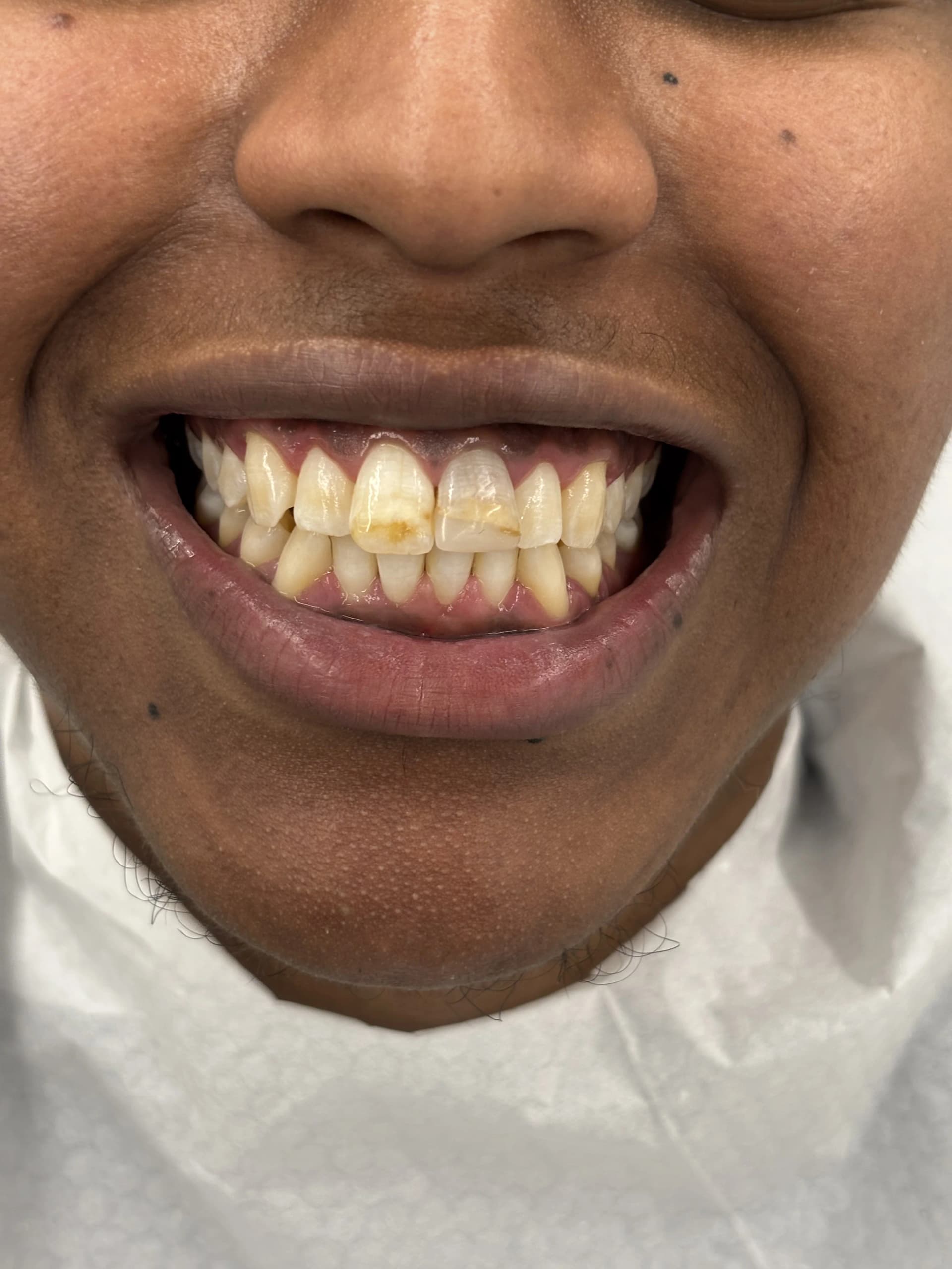 Veneers & smile design after — case 10, NexWell partner clinic, Istanbul