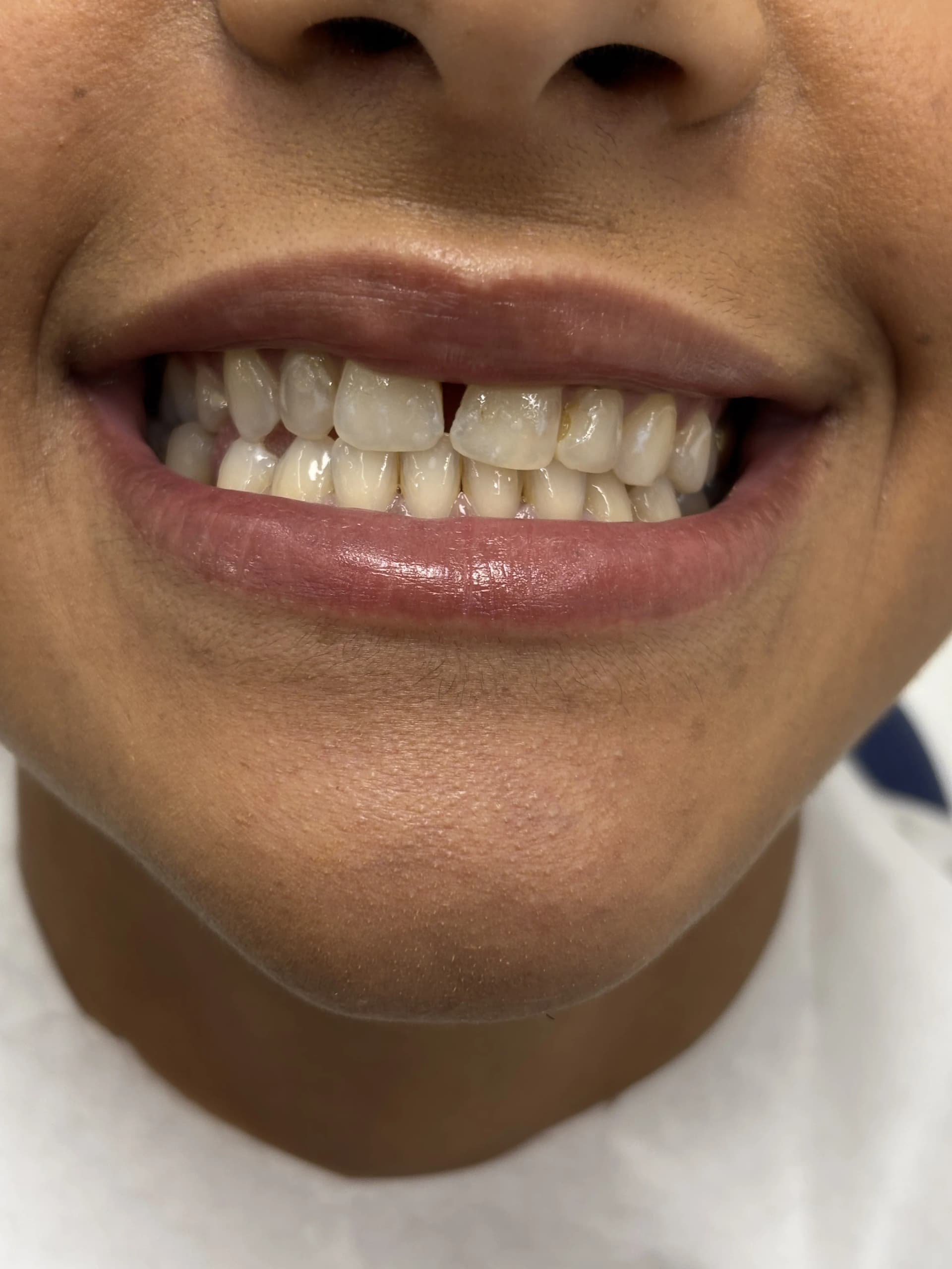 Smile makeover after — case 11, NexWell partner clinic, Istanbul