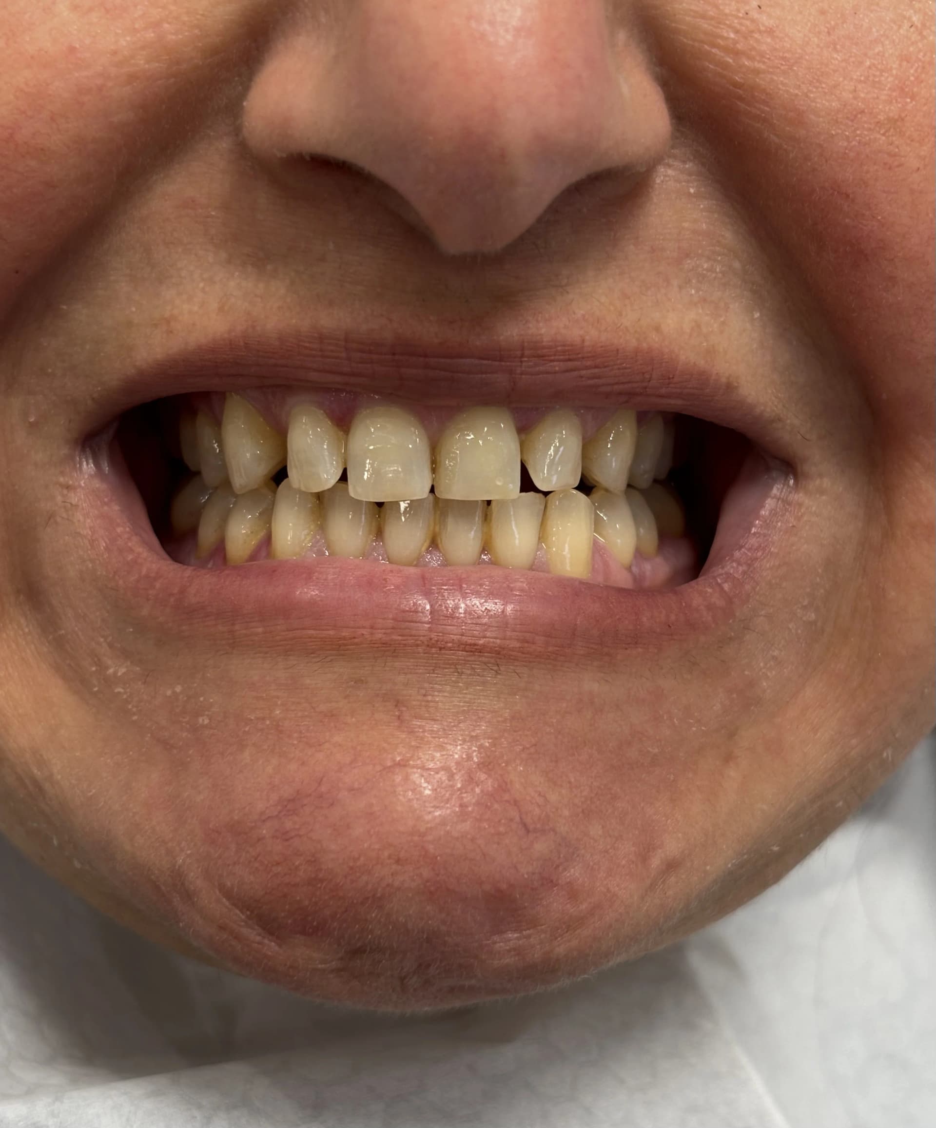Implant & full-arch restoration after — case 12, NexWell partner clinic, Istanbul