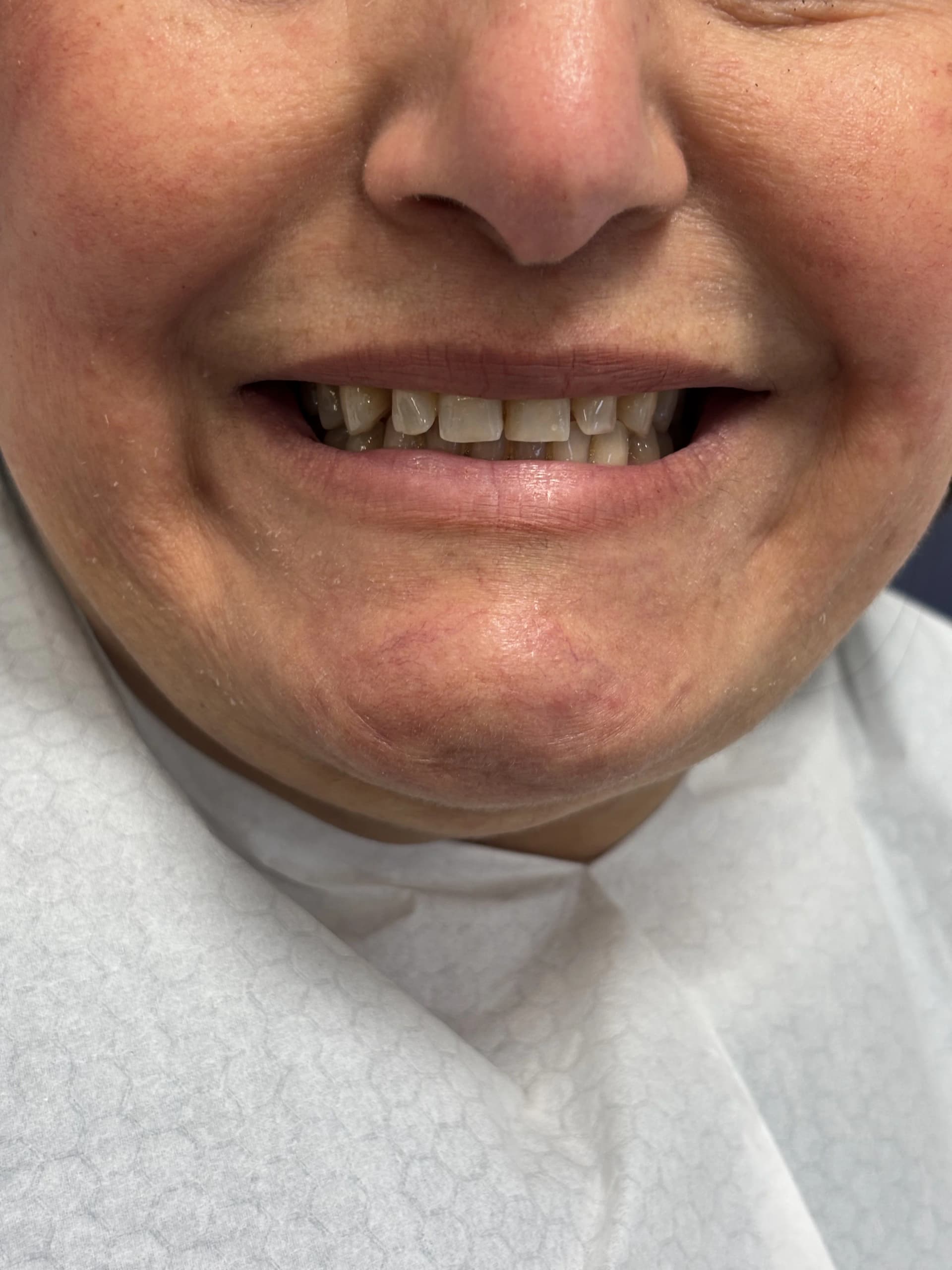 Implant & full-arch restoration before — case 12, partner clinic, Istanbul