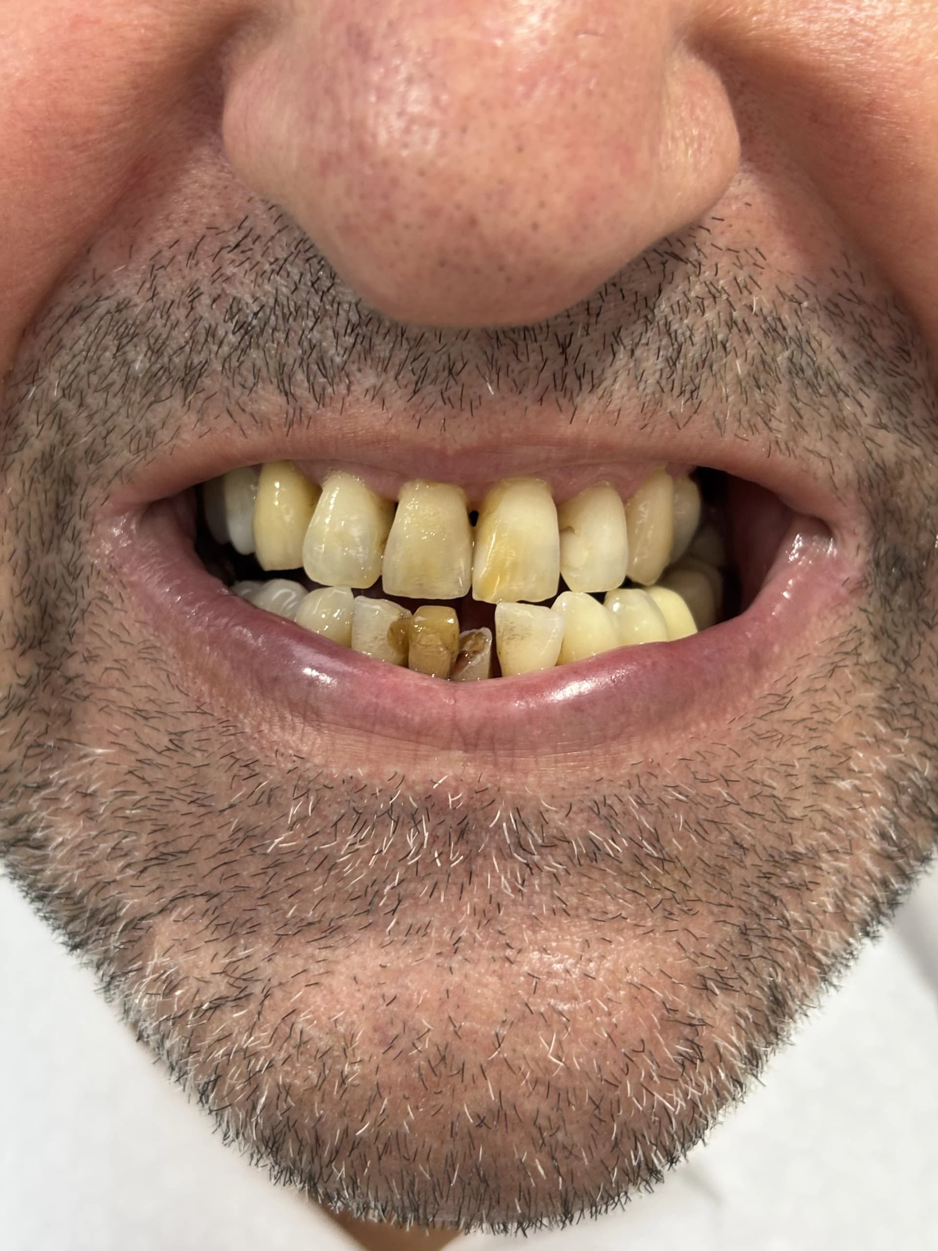 Veneers & smile design after — case 13, NexWell partner clinic, Istanbul