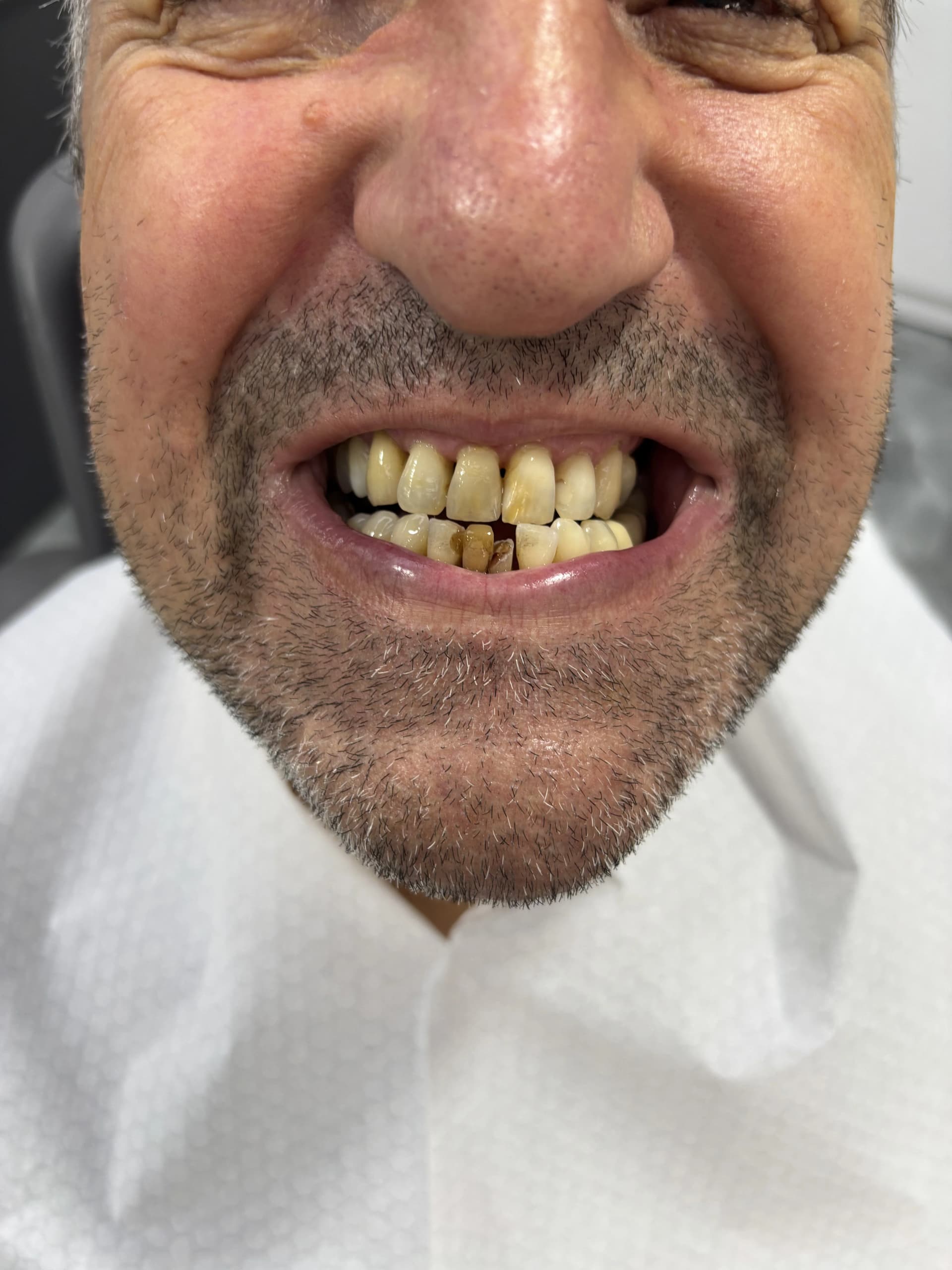 Veneers & smile design before — case 13, partner clinic, Istanbul