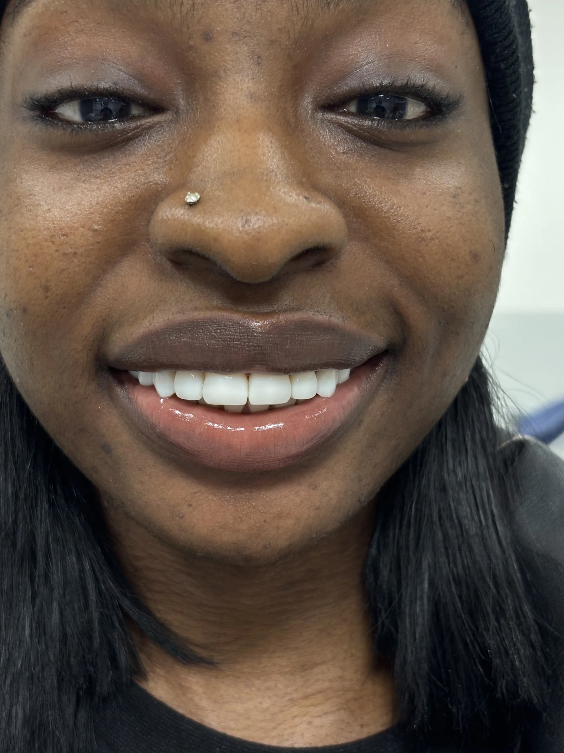 Smile makeover after — case 14, NexWell partner clinic, Istanbul