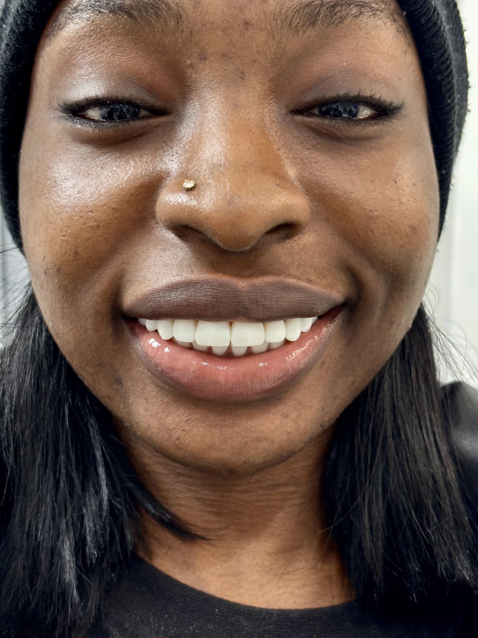 Smile makeover before — case 14, partner clinic, Istanbul