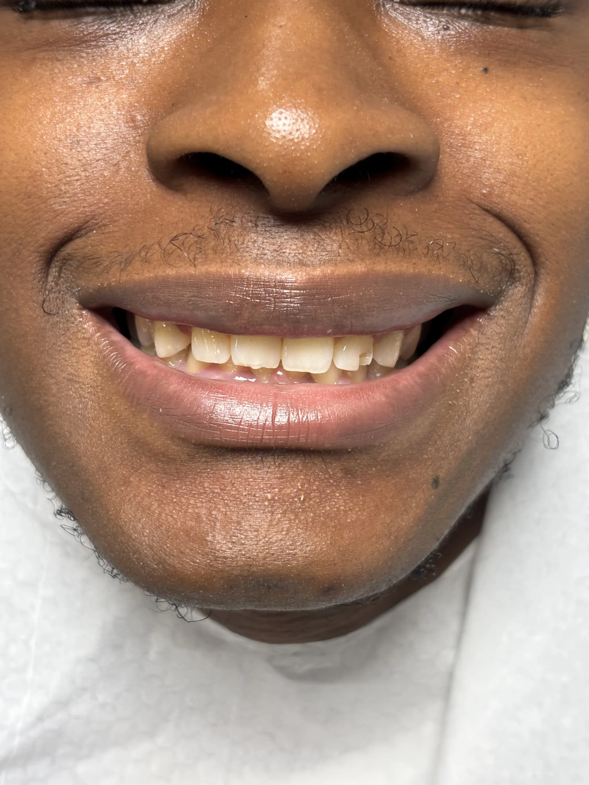Implant & full-arch restoration after — case 15, NexWell partner clinic, Istanbul