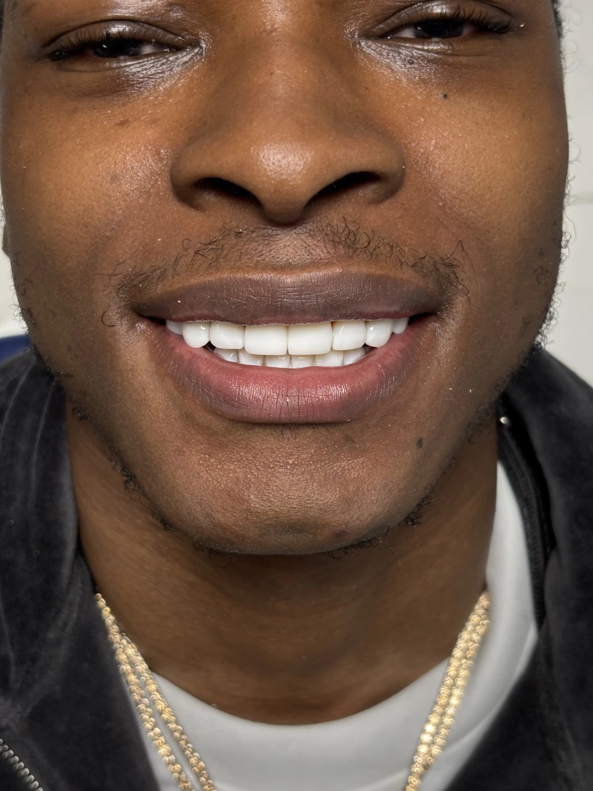Veneers & smile design before — case 16, partner clinic, Istanbul