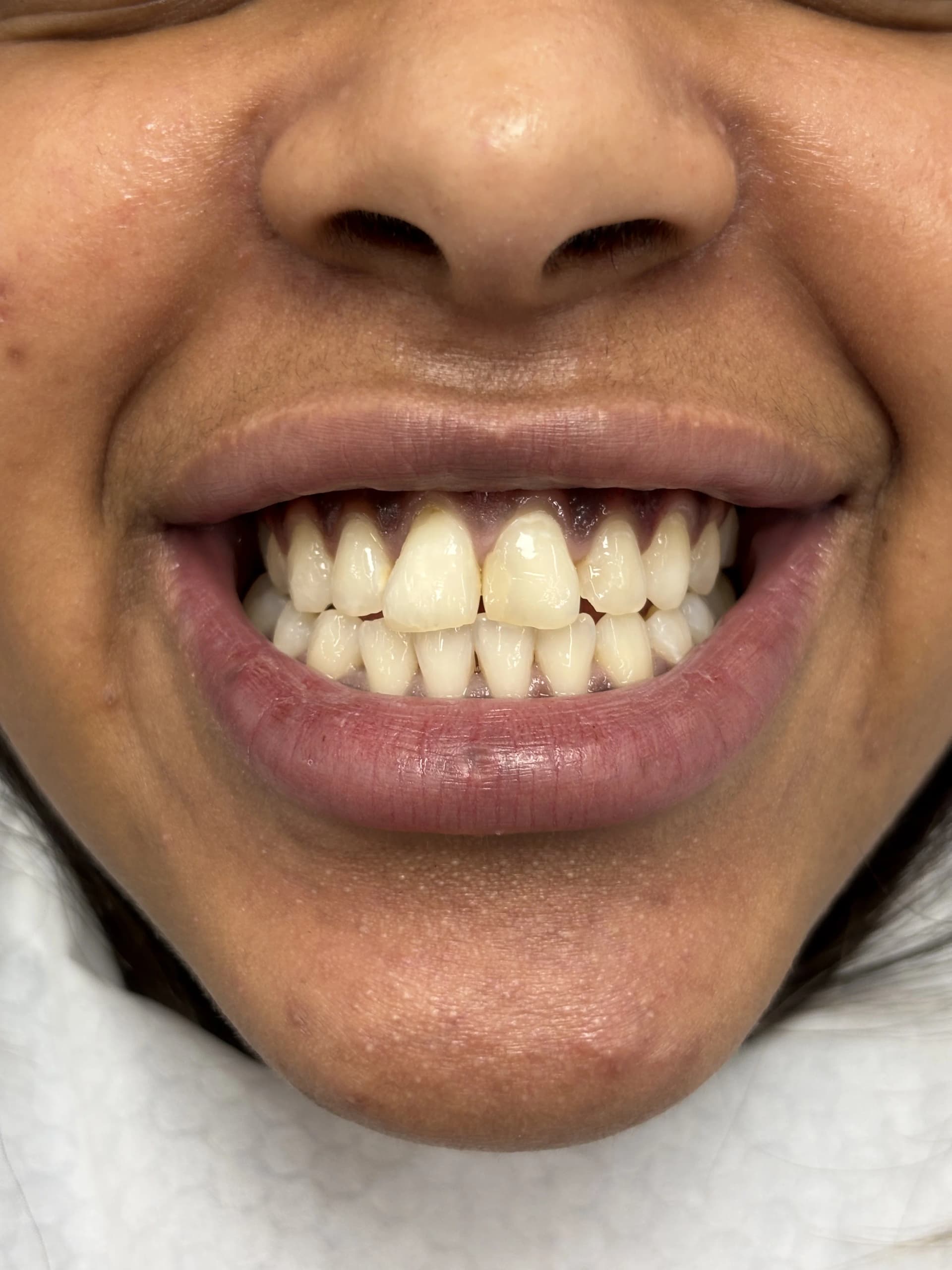 Smile makeover after — case 17, NexWell partner clinic, Istanbul