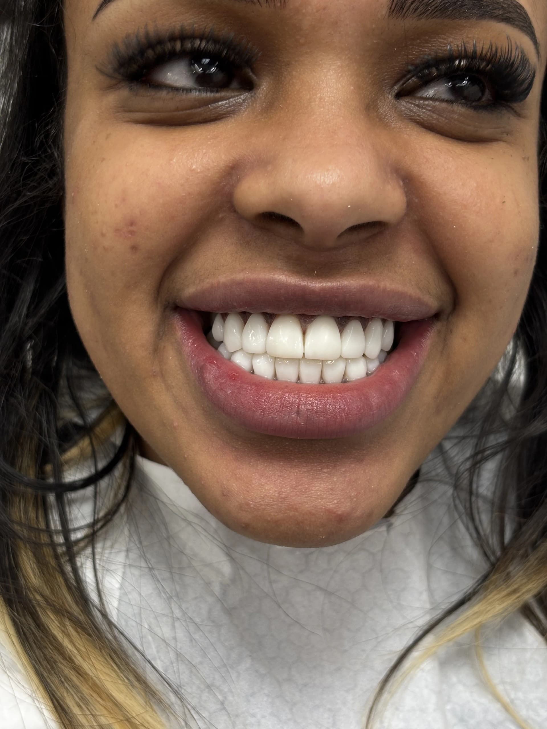 Implant & full-arch restoration after — case 18, NexWell partner clinic, Istanbul