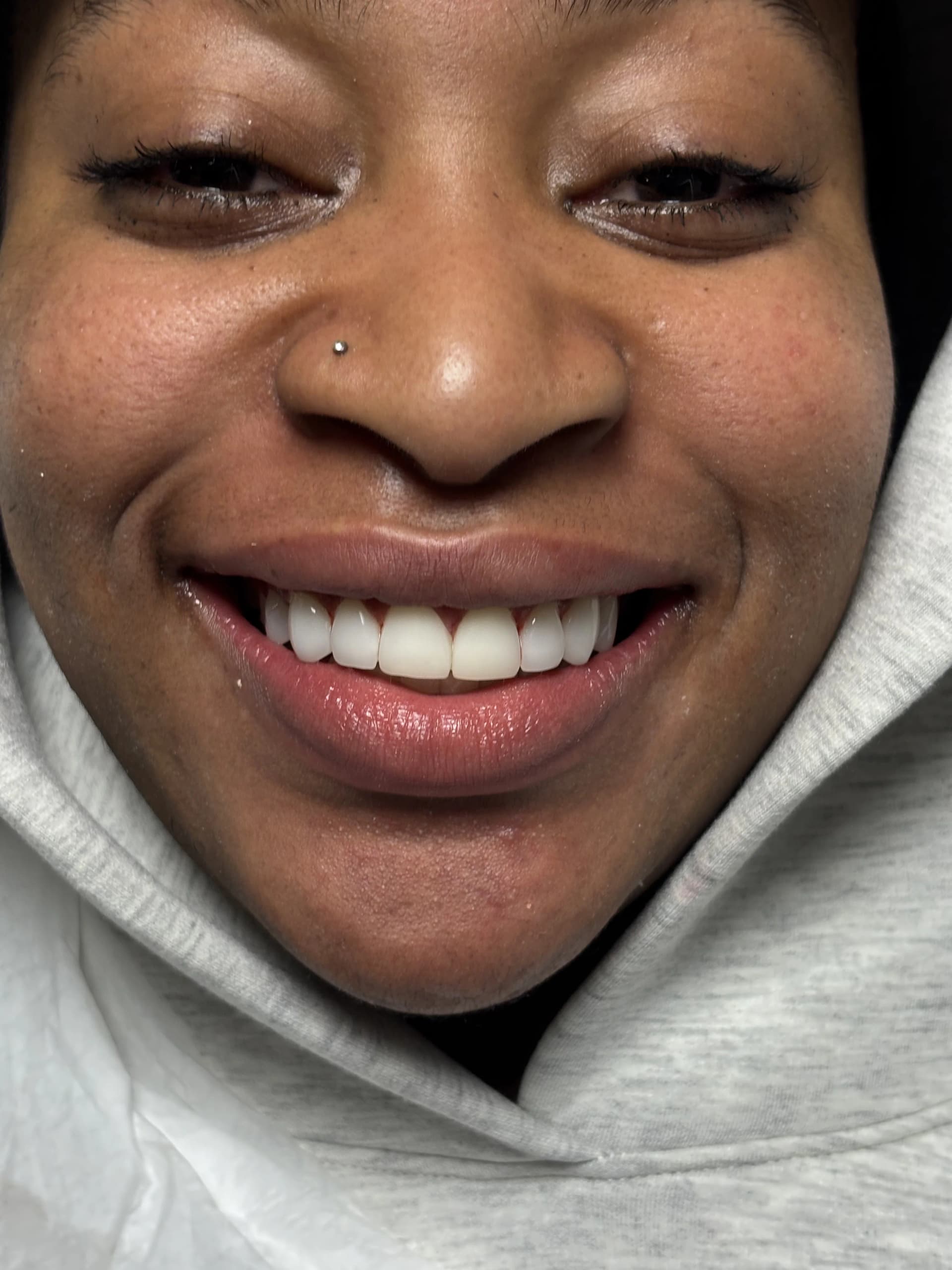 Veneers & smile design after — case 19, NexWell partner clinic, Istanbul