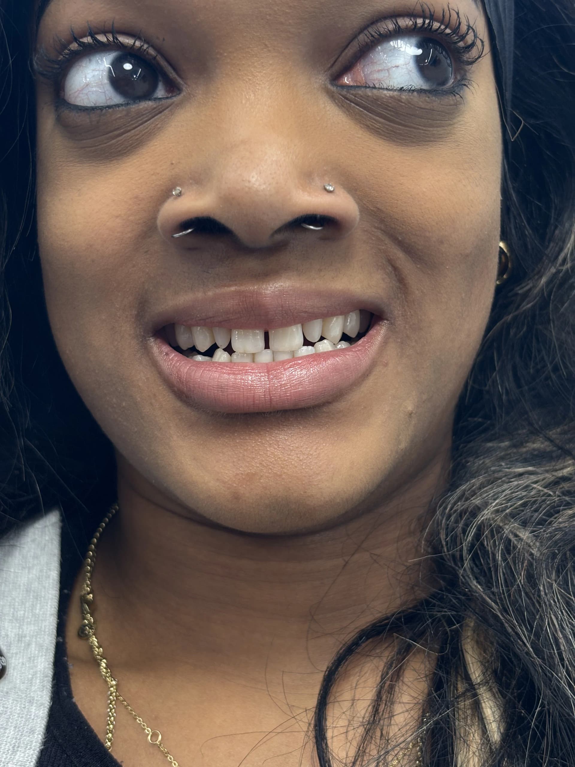 Smile makeover after — case 20, NexWell partner clinic, Istanbul
