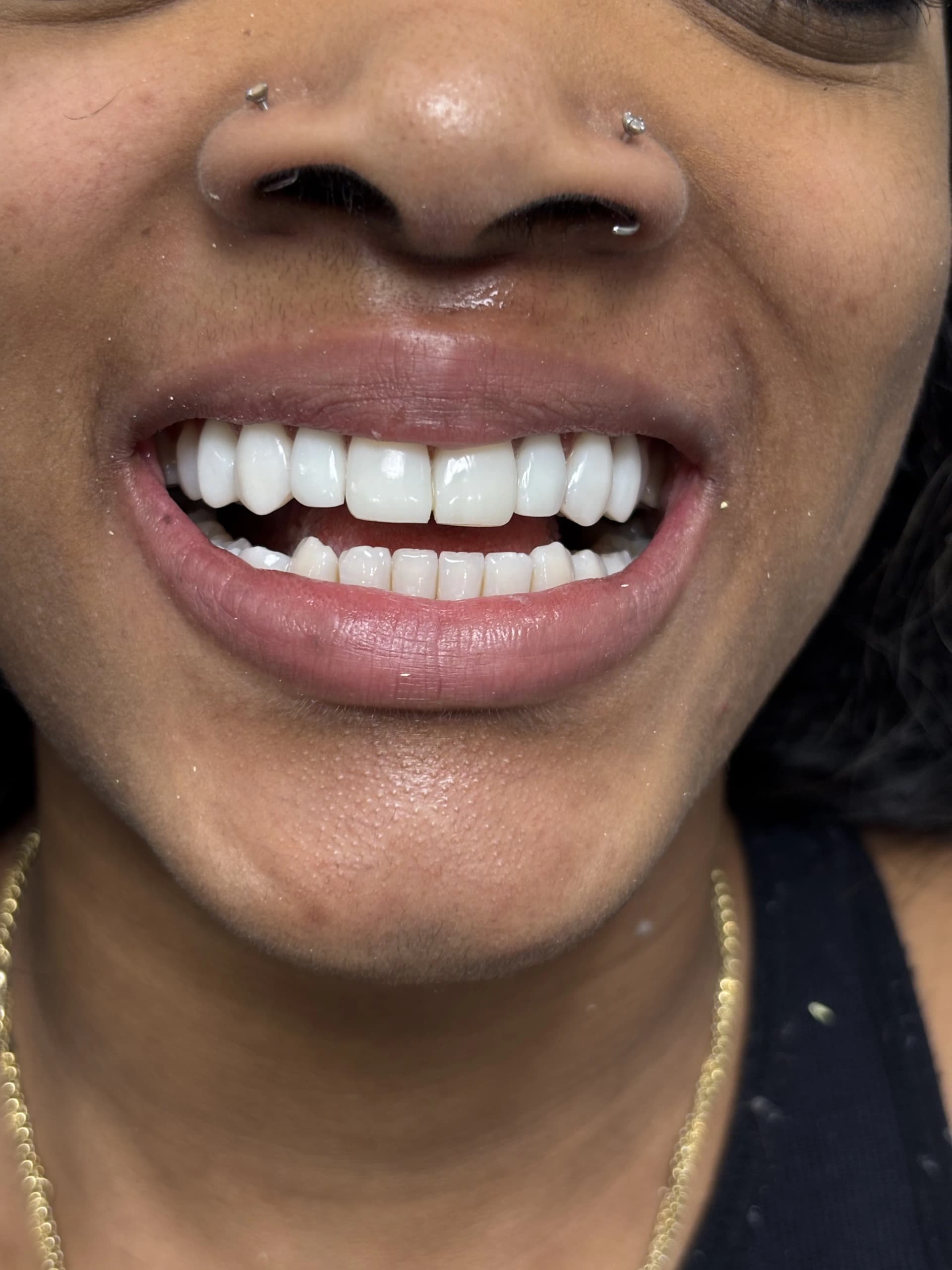 Implant & full-arch restoration after — case 21, NexWell partner clinic, Istanbul