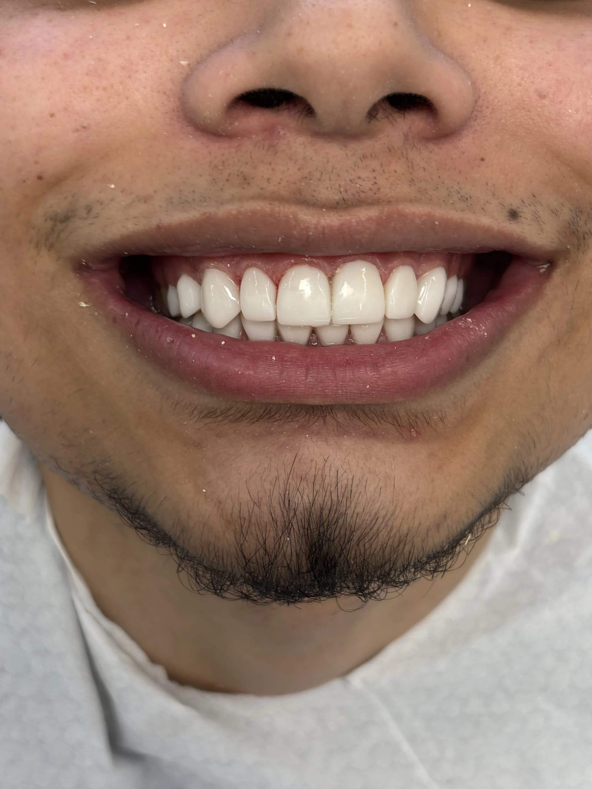 Veneers & smile design after — case 22, NexWell partner clinic, Istanbul