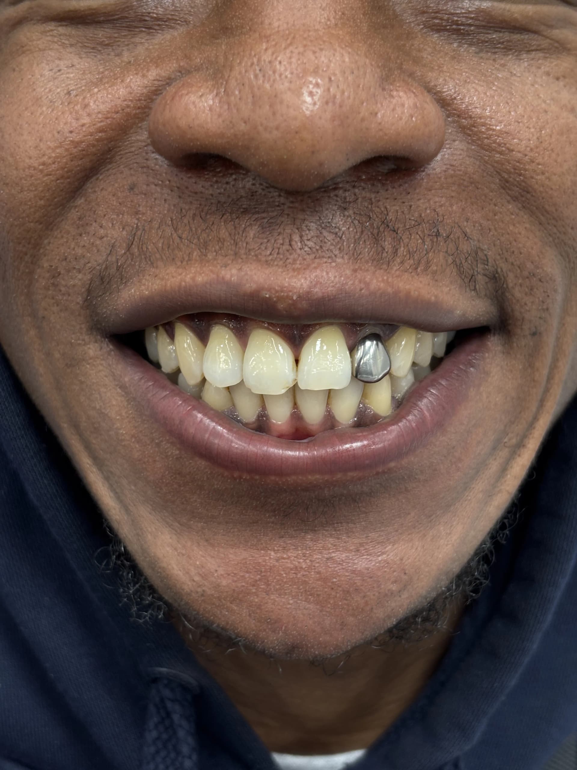 Smile makeover after — case 23, NexWell partner clinic, Istanbul