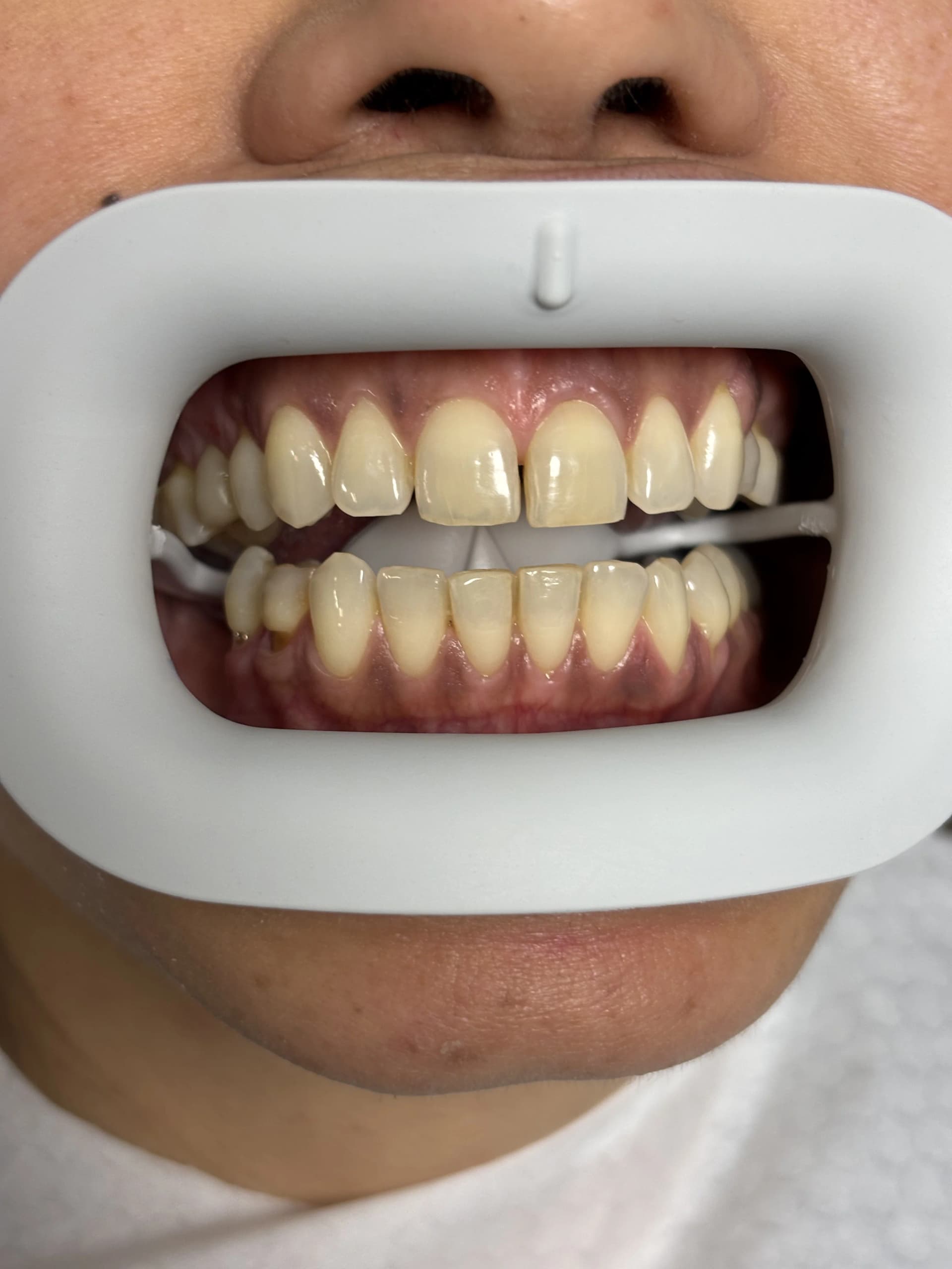 Implant & full-arch restoration after — case 24, NexWell partner clinic, Istanbul