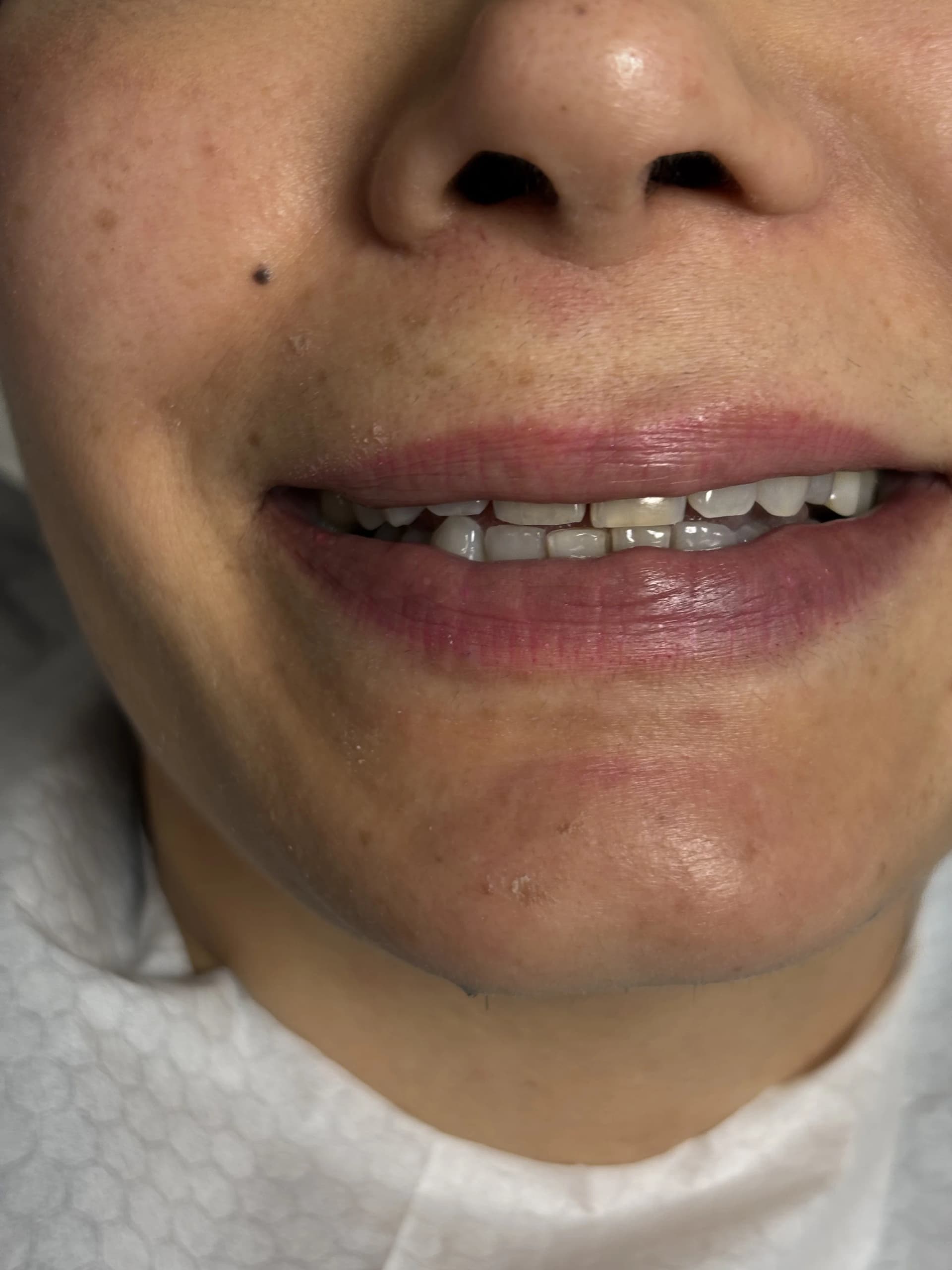 Implant & full-arch restoration before — case 24, partner clinic, Istanbul