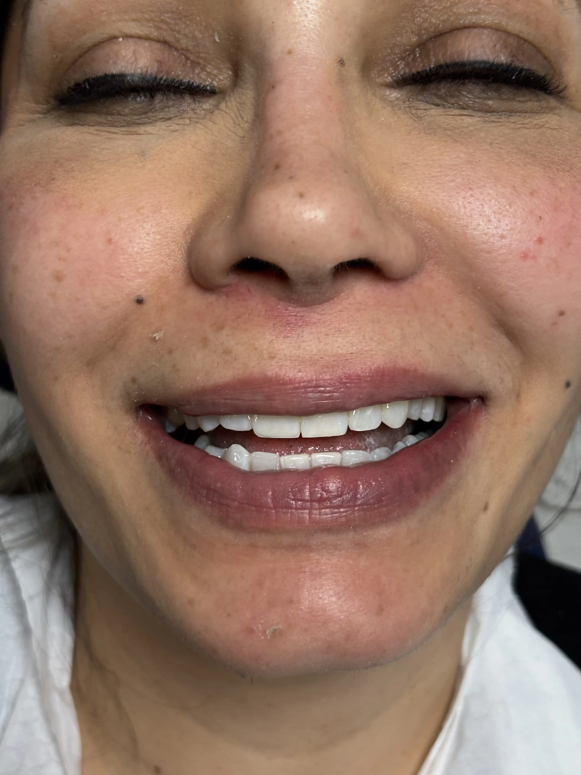 Veneers & smile design after — case 25, NexWell partner clinic, Istanbul