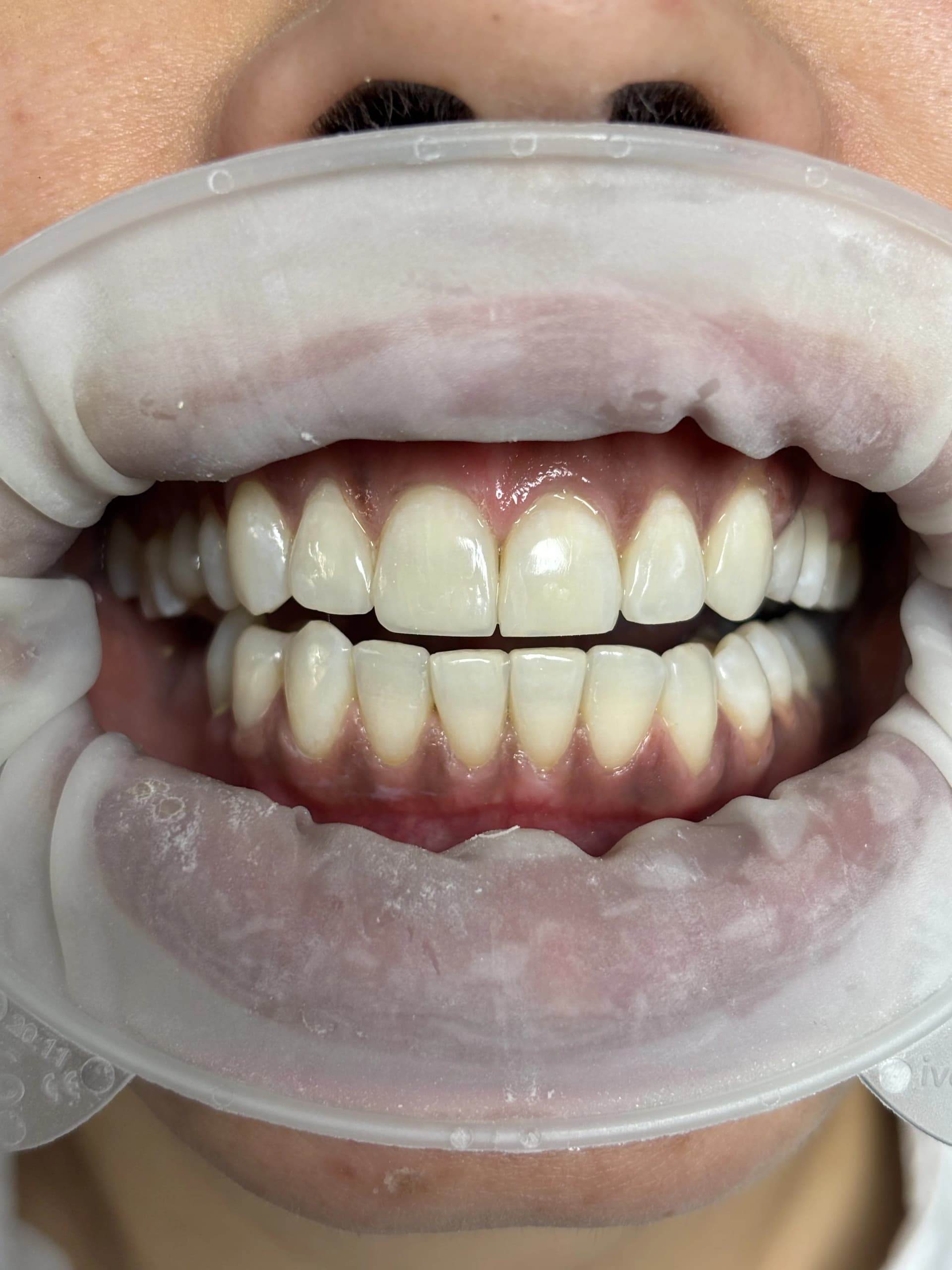 Veneers & smile design before — case 25, partner clinic, Istanbul