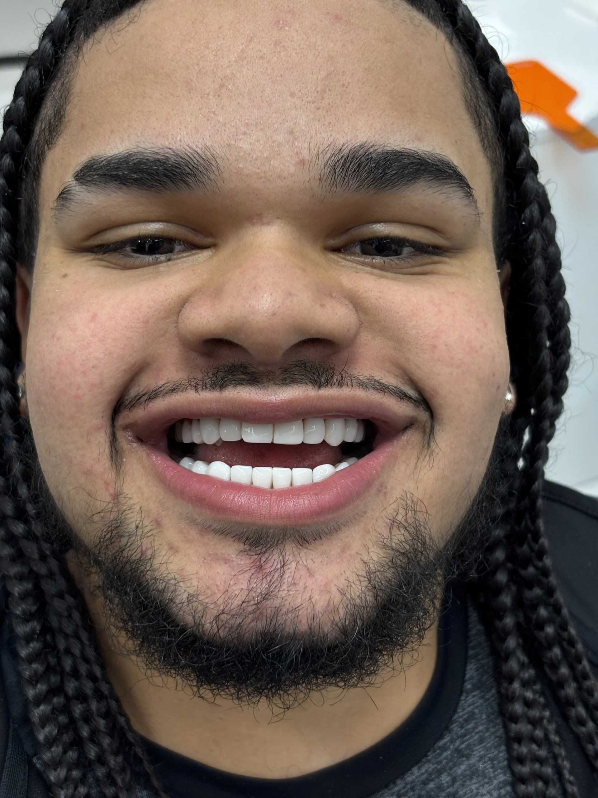 Smile makeover after — case 26, NexWell partner clinic, Istanbul