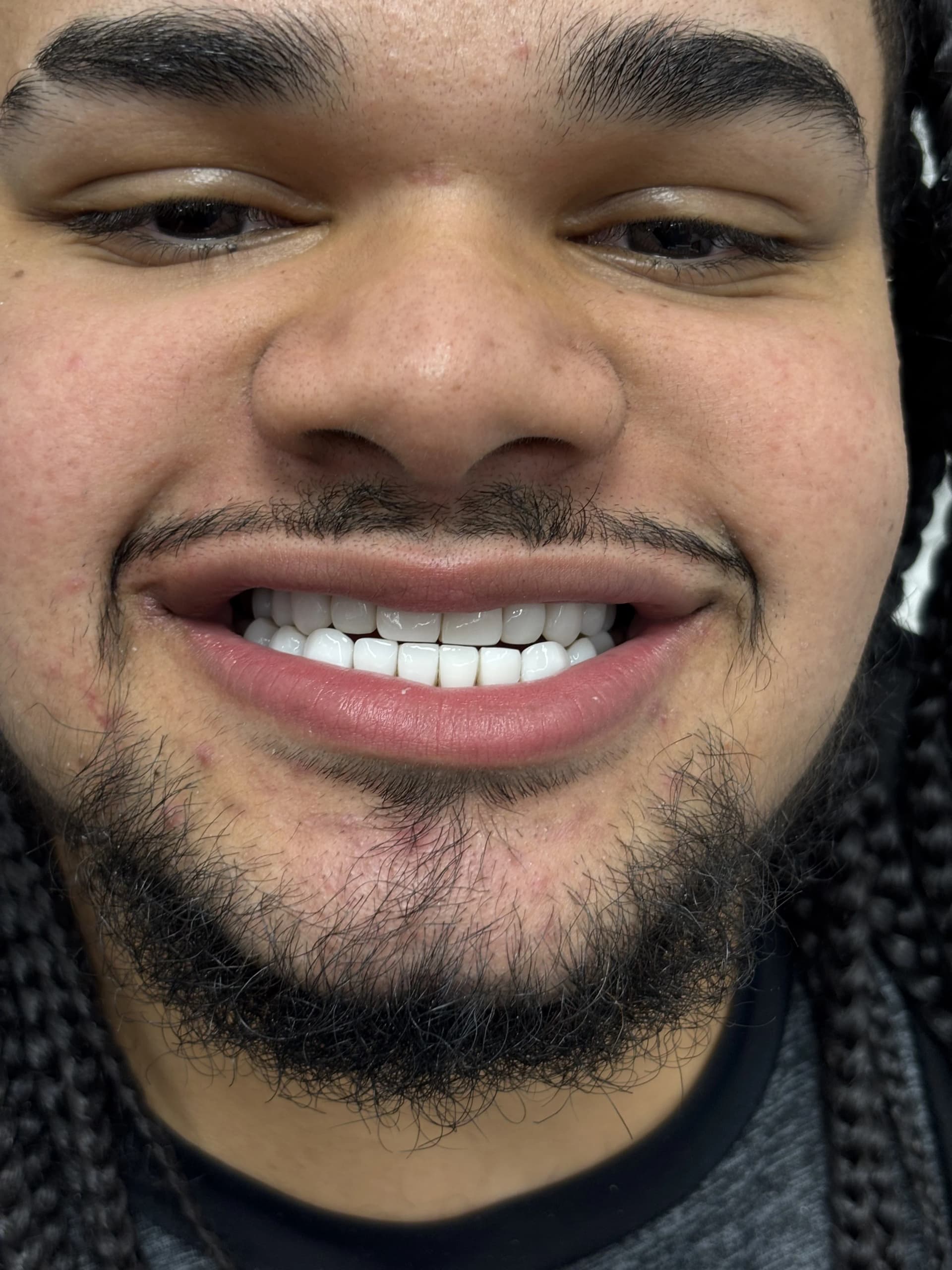 Smile makeover before — case 26, partner clinic, Istanbul