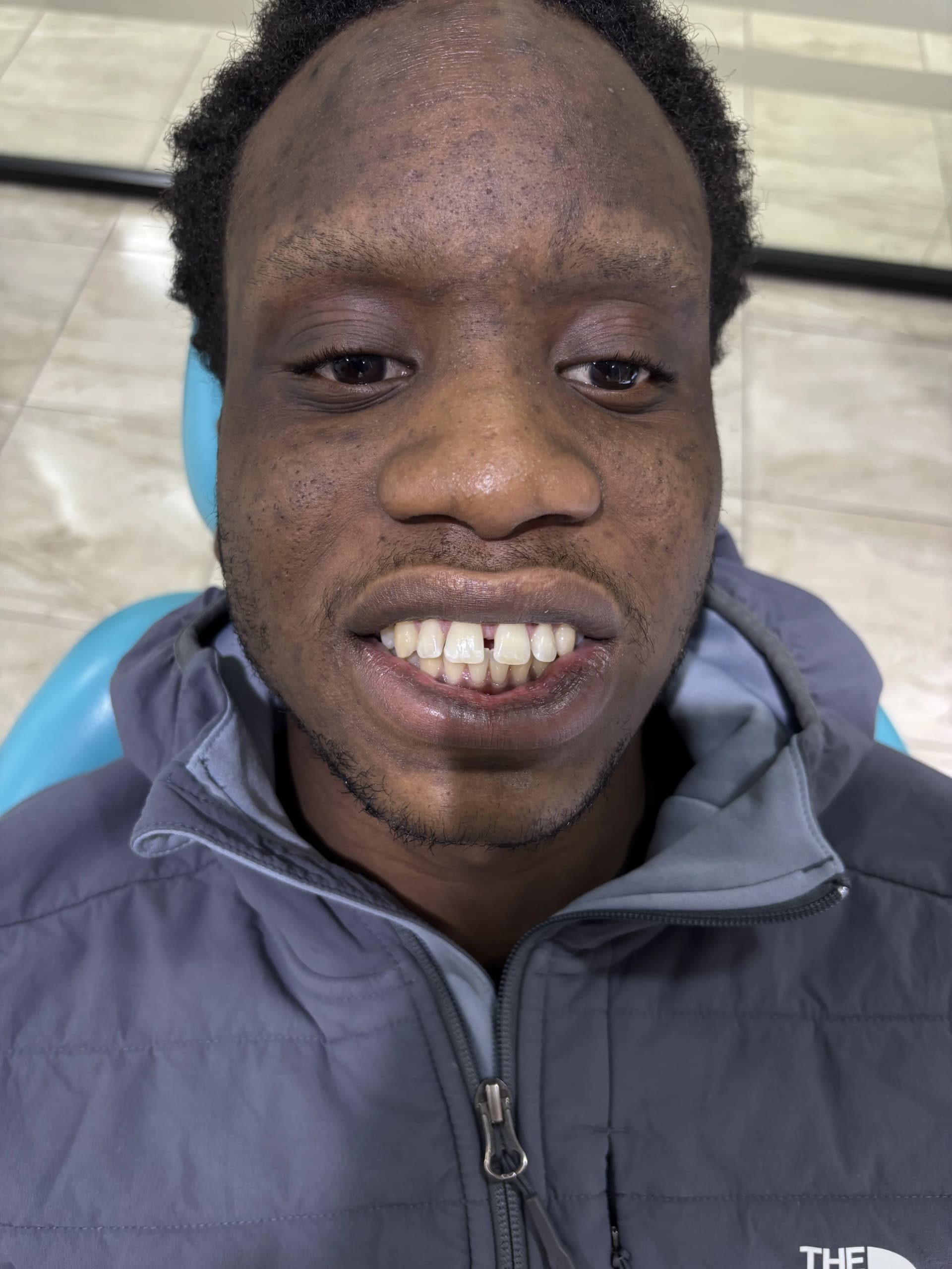 Implant & full-arch restoration after — case 27, NexWell partner clinic, Istanbul