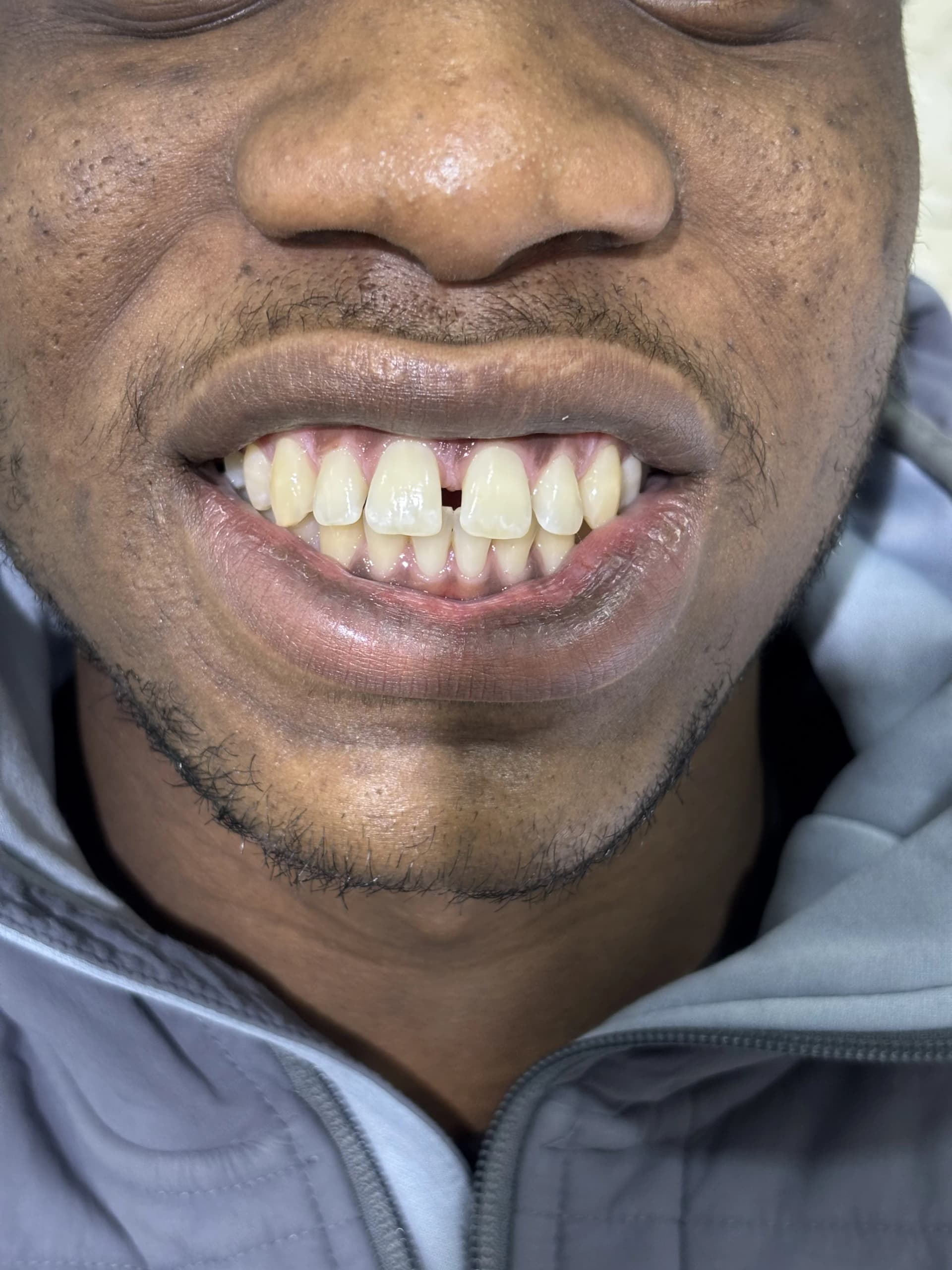 Implant & full-arch restoration before — case 27, partner clinic, Istanbul