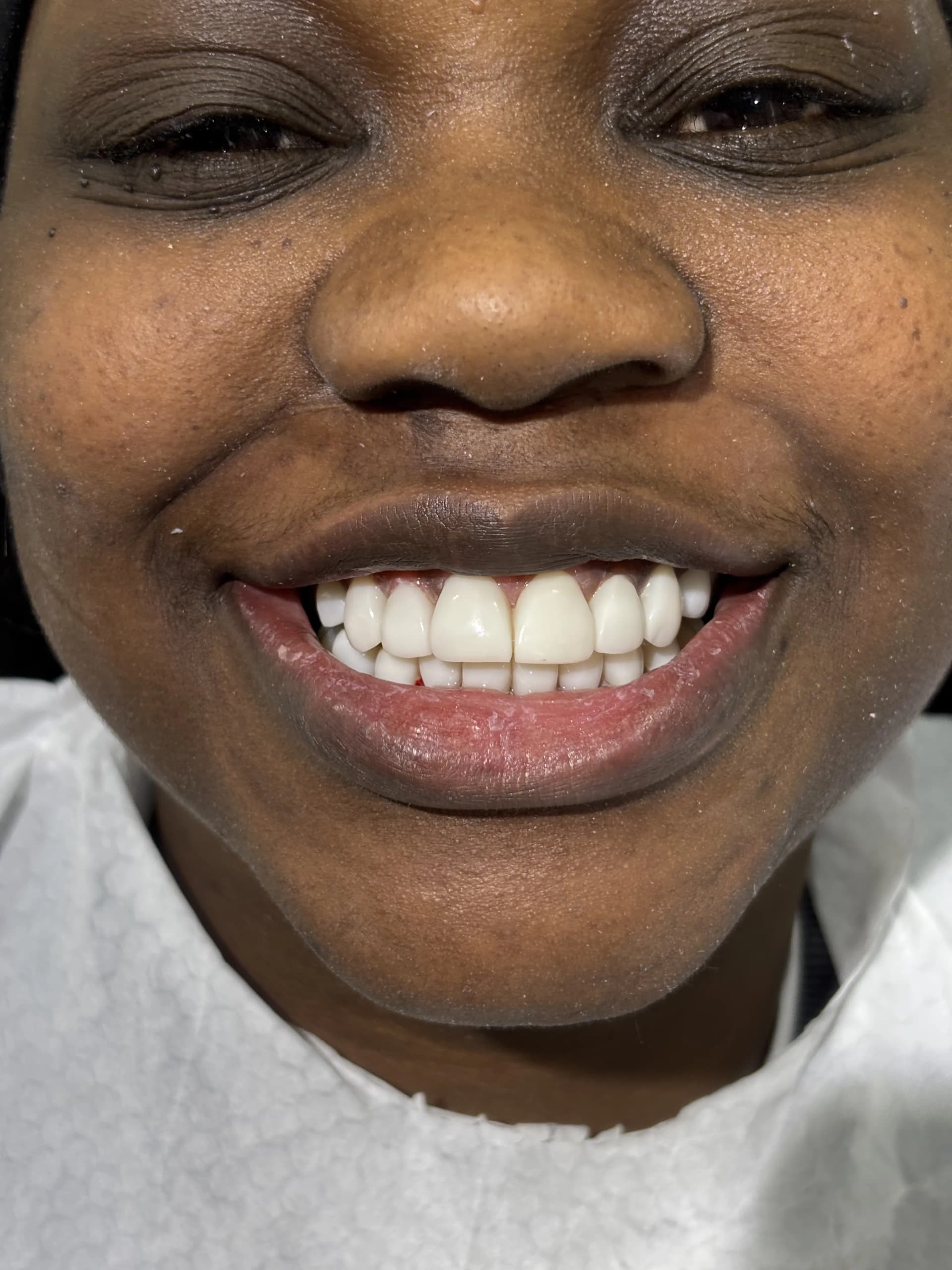 Veneers & smile design after — case 28, NexWell partner clinic, Istanbul