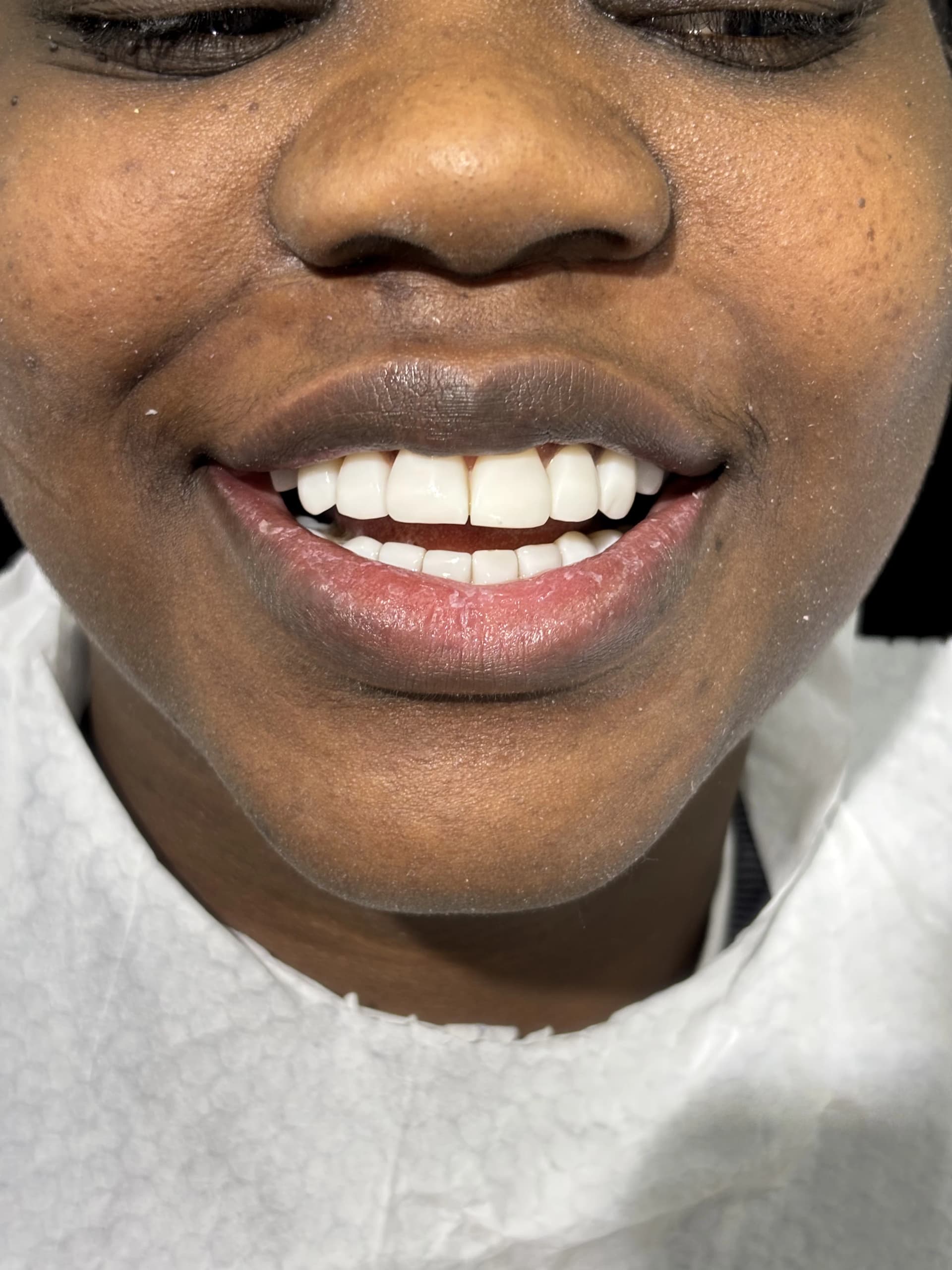 Veneers & smile design before — case 28, partner clinic, Istanbul