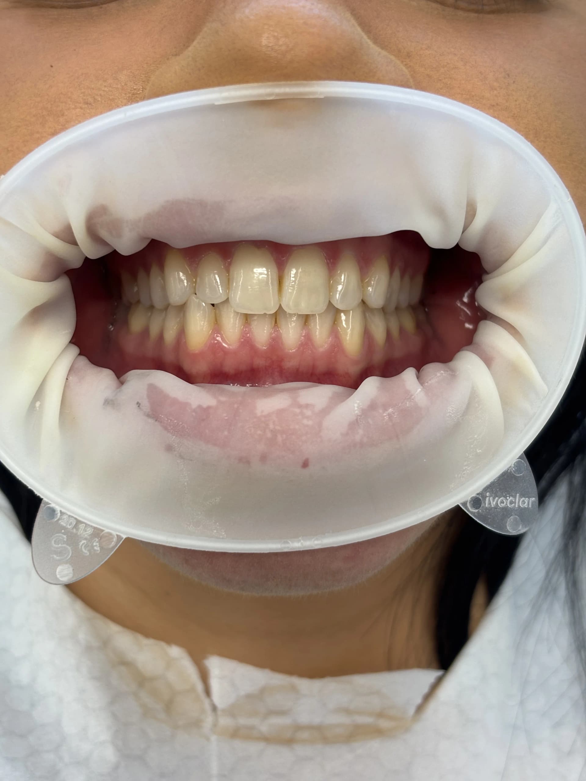 Smile makeover after — case 29, NexWell partner clinic, Istanbul