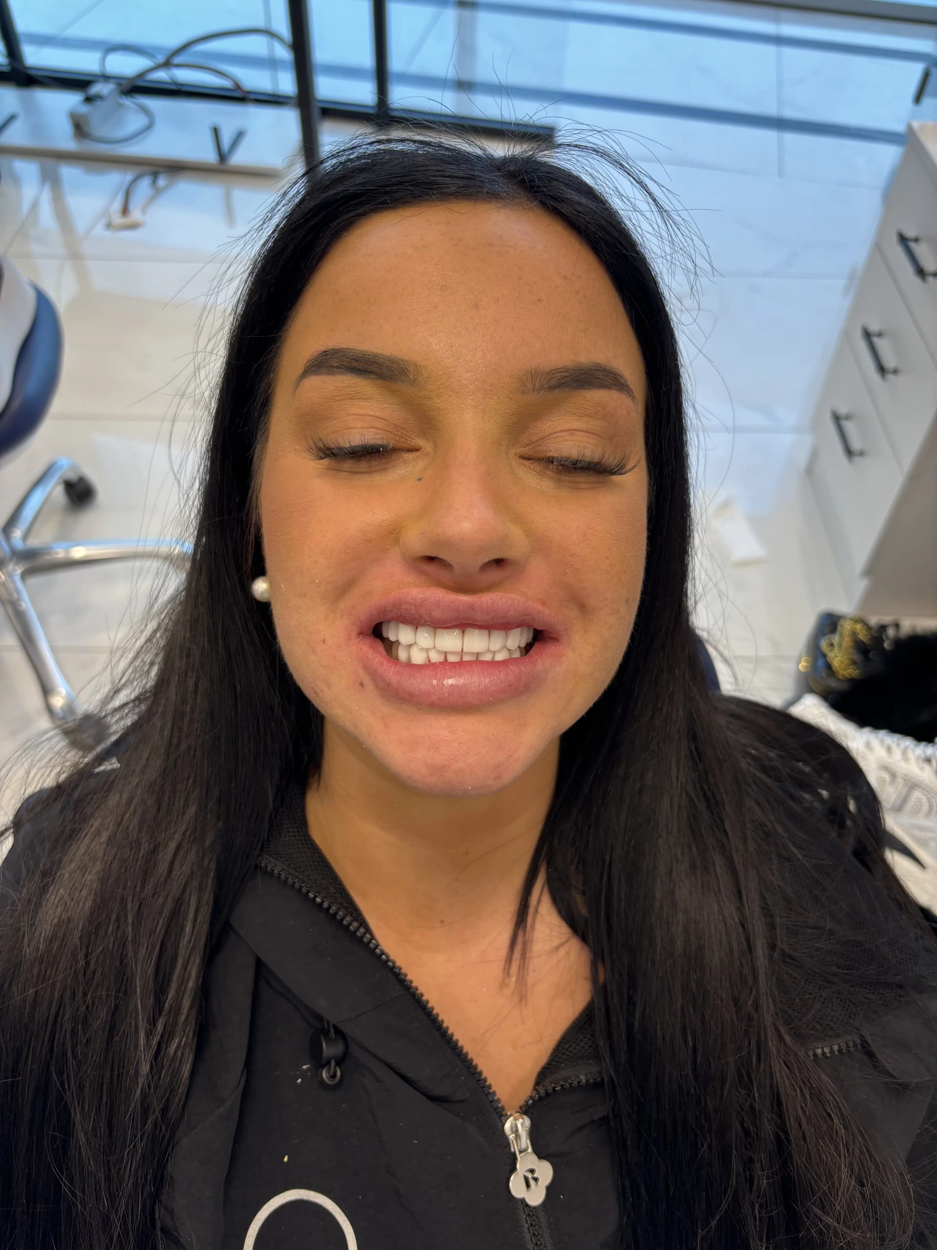 Implant & full-arch restoration after — case 30, NexWell partner clinic, Istanbul