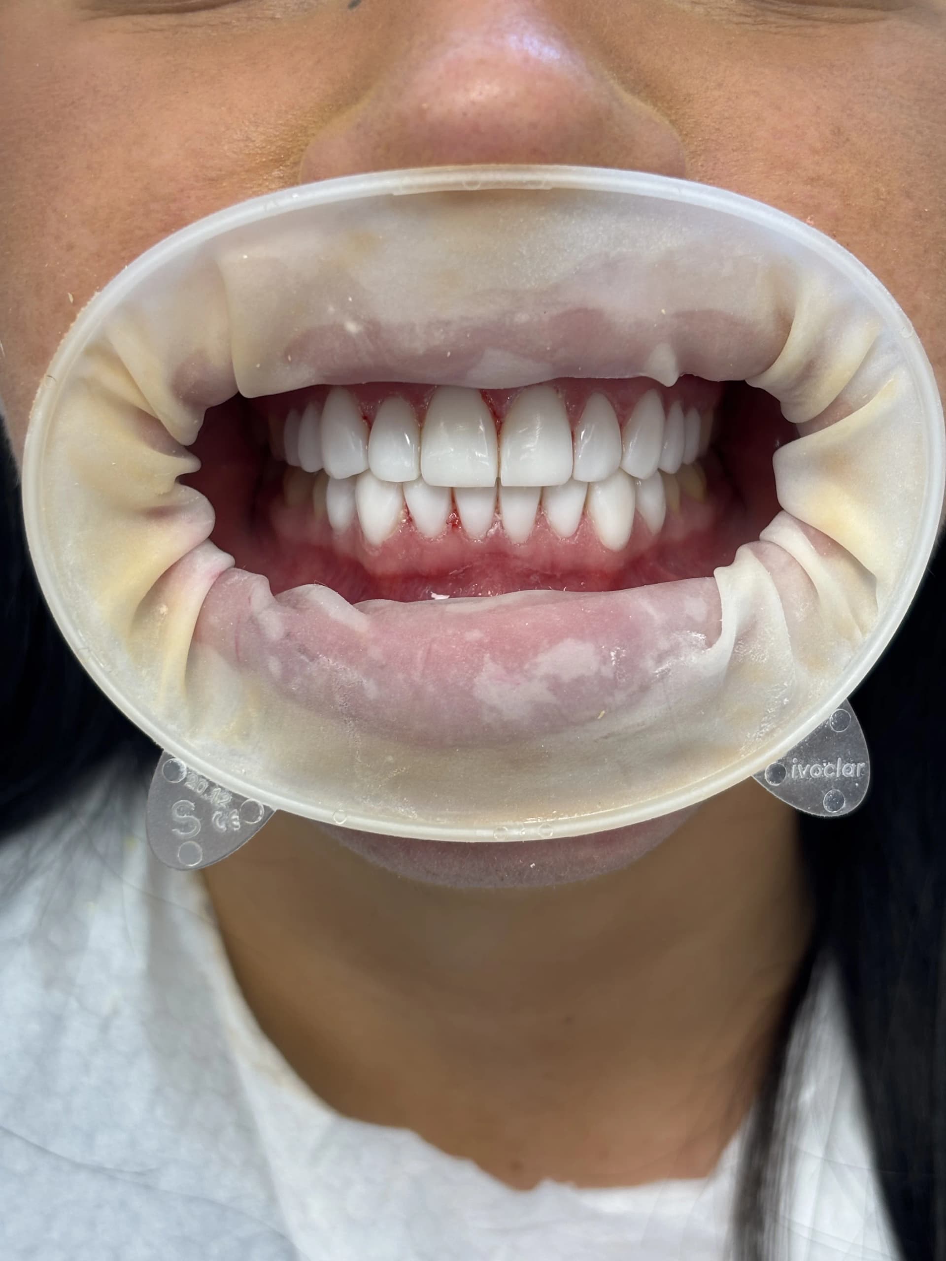 Implant & full-arch restoration before — case 30, partner clinic, Istanbul