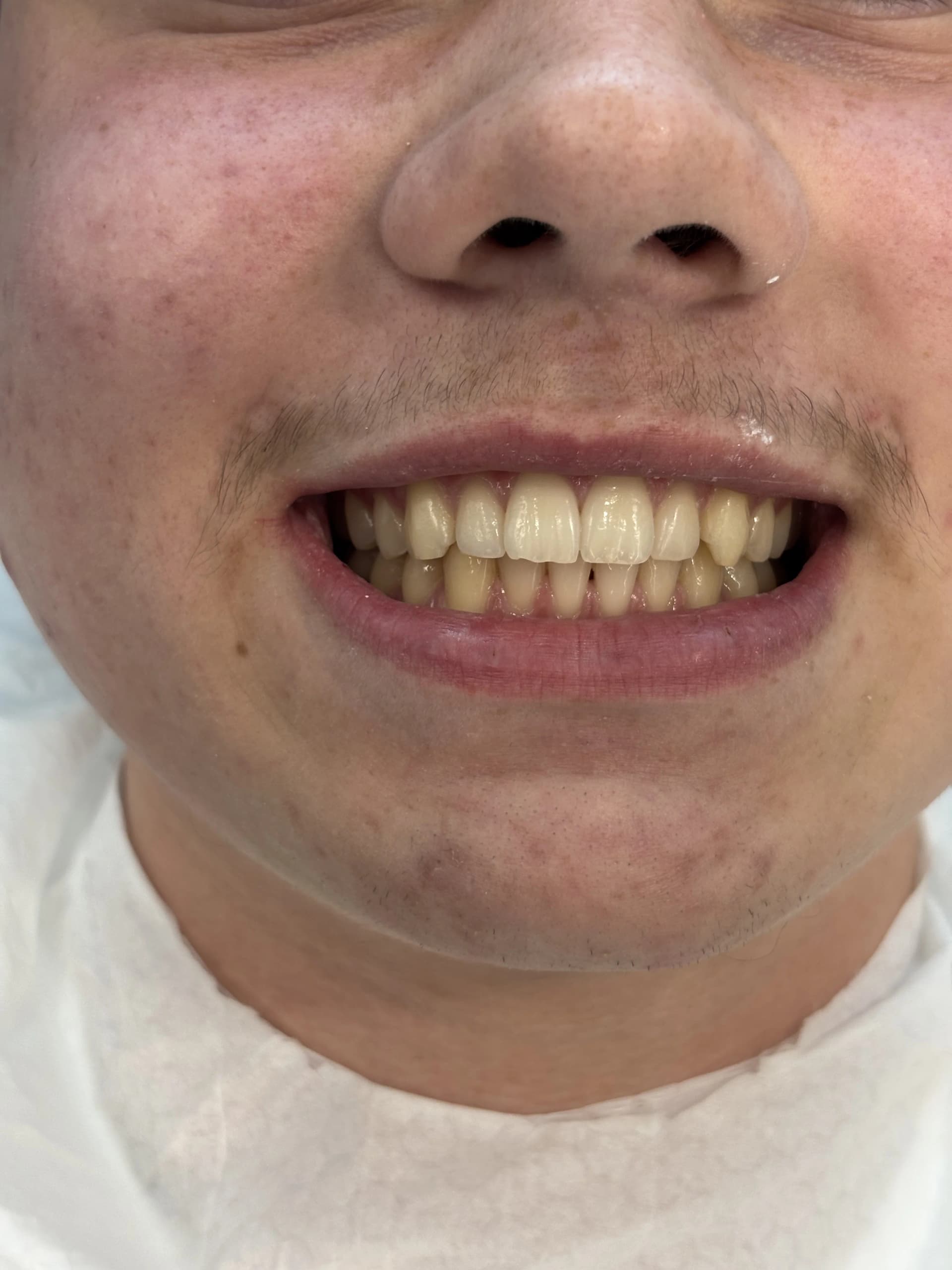 Veneers & smile design after — case 31, NexWell partner clinic, Istanbul